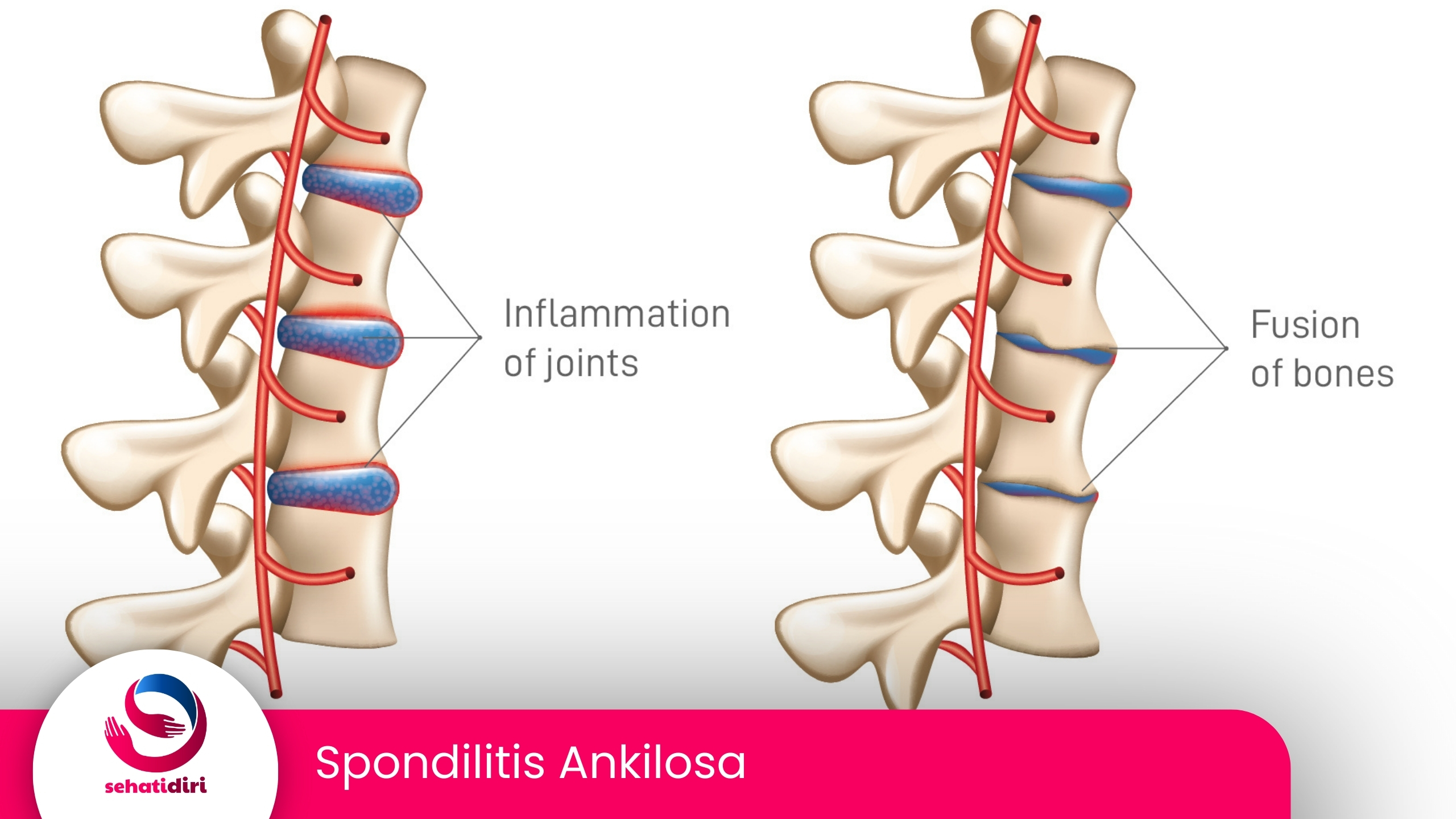 Spondilitis Ankilosa