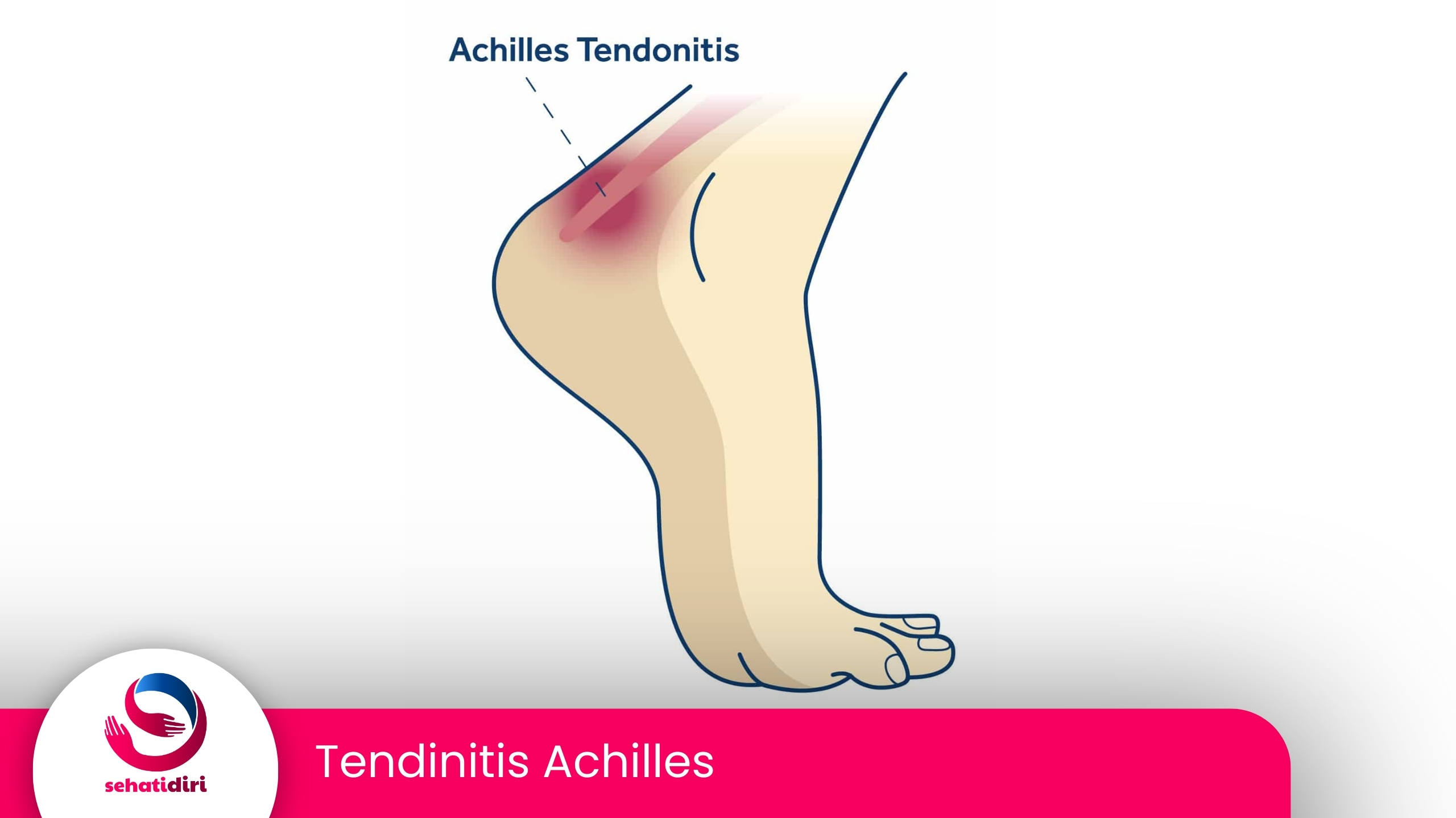 Tendinitis Achilles