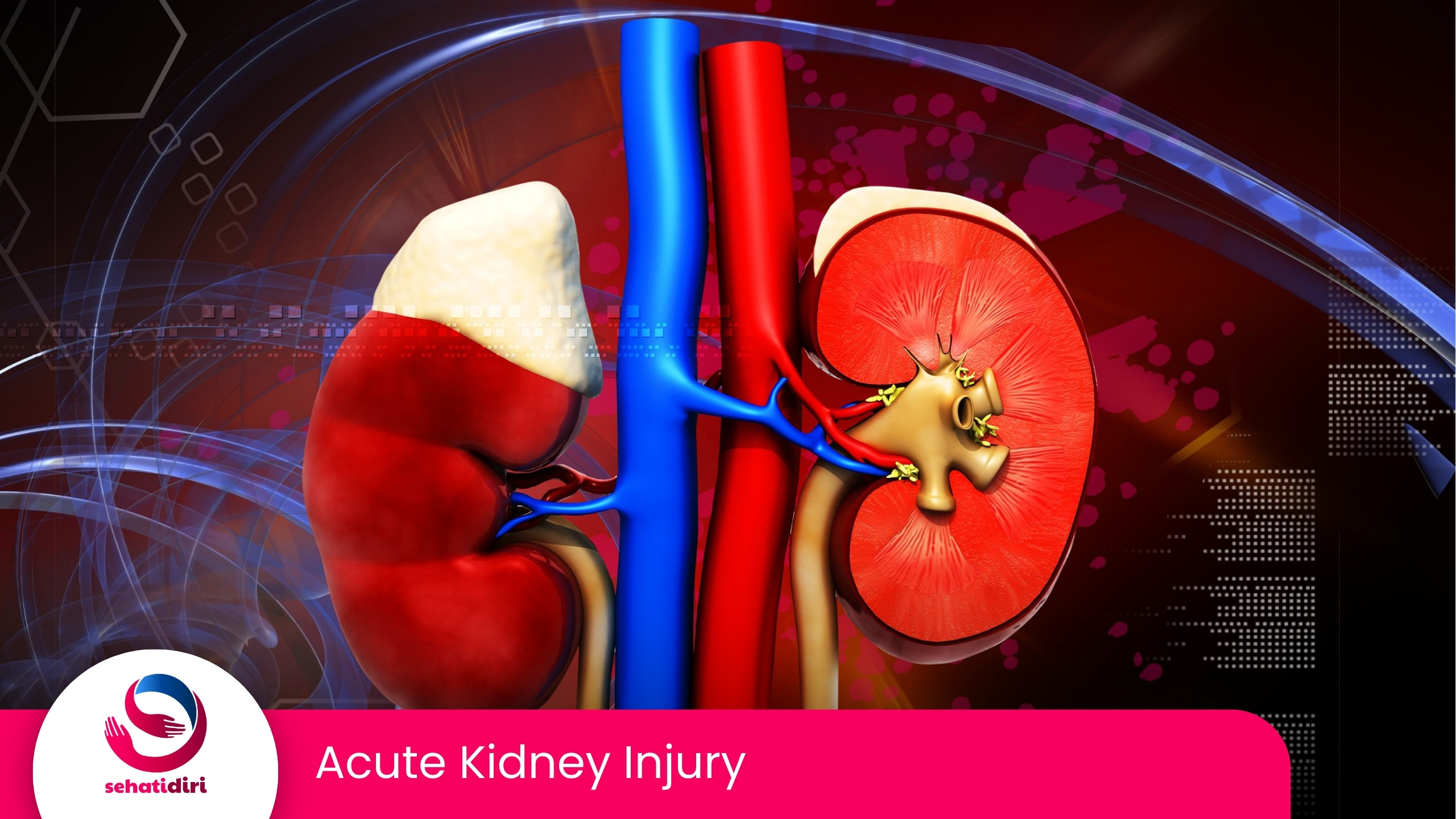 Acute Kidney Injury