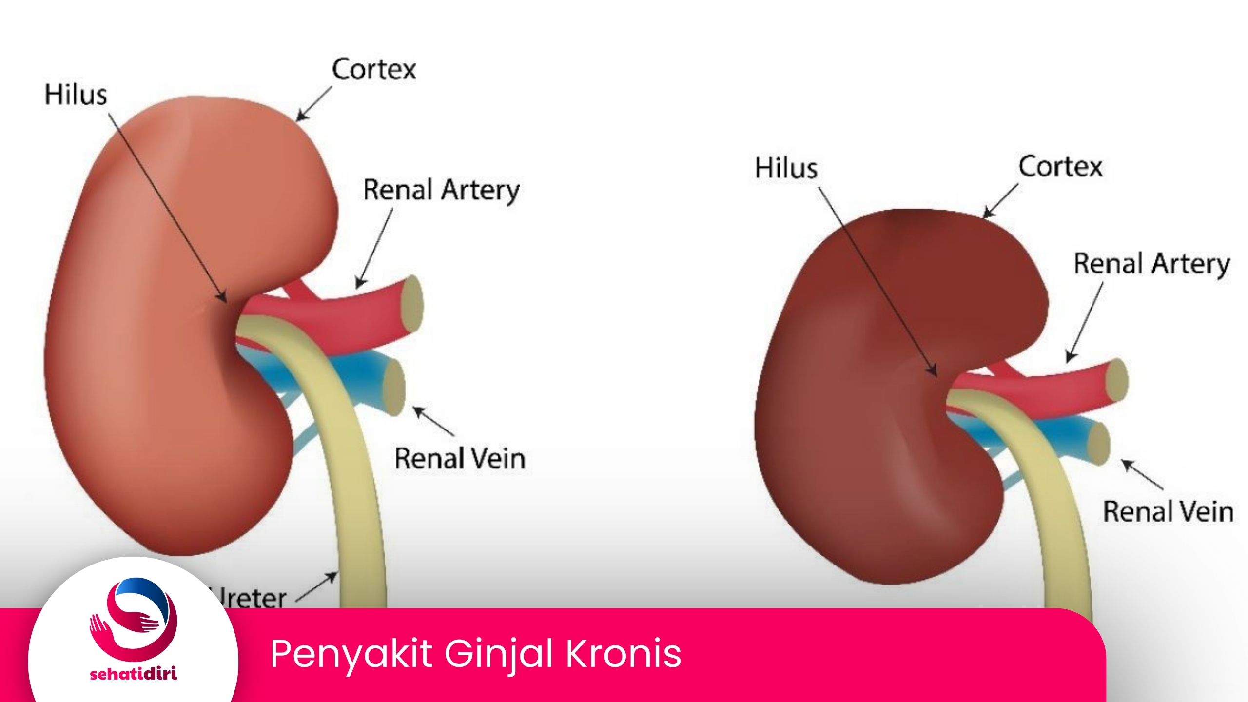 Penyakit Ginjal Kronis