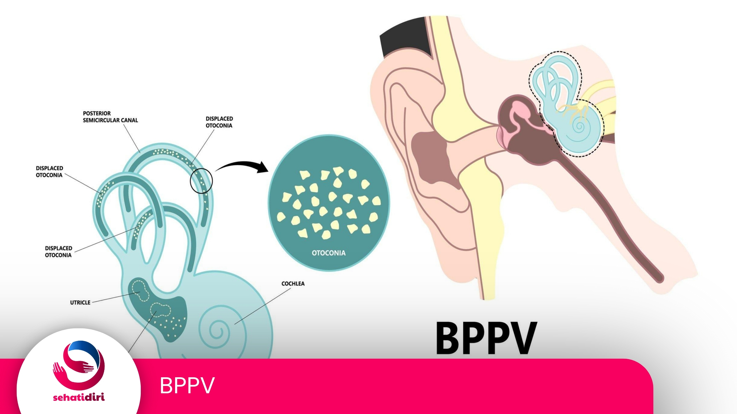 BPPV (Benign Paroxysmal Vertigo)