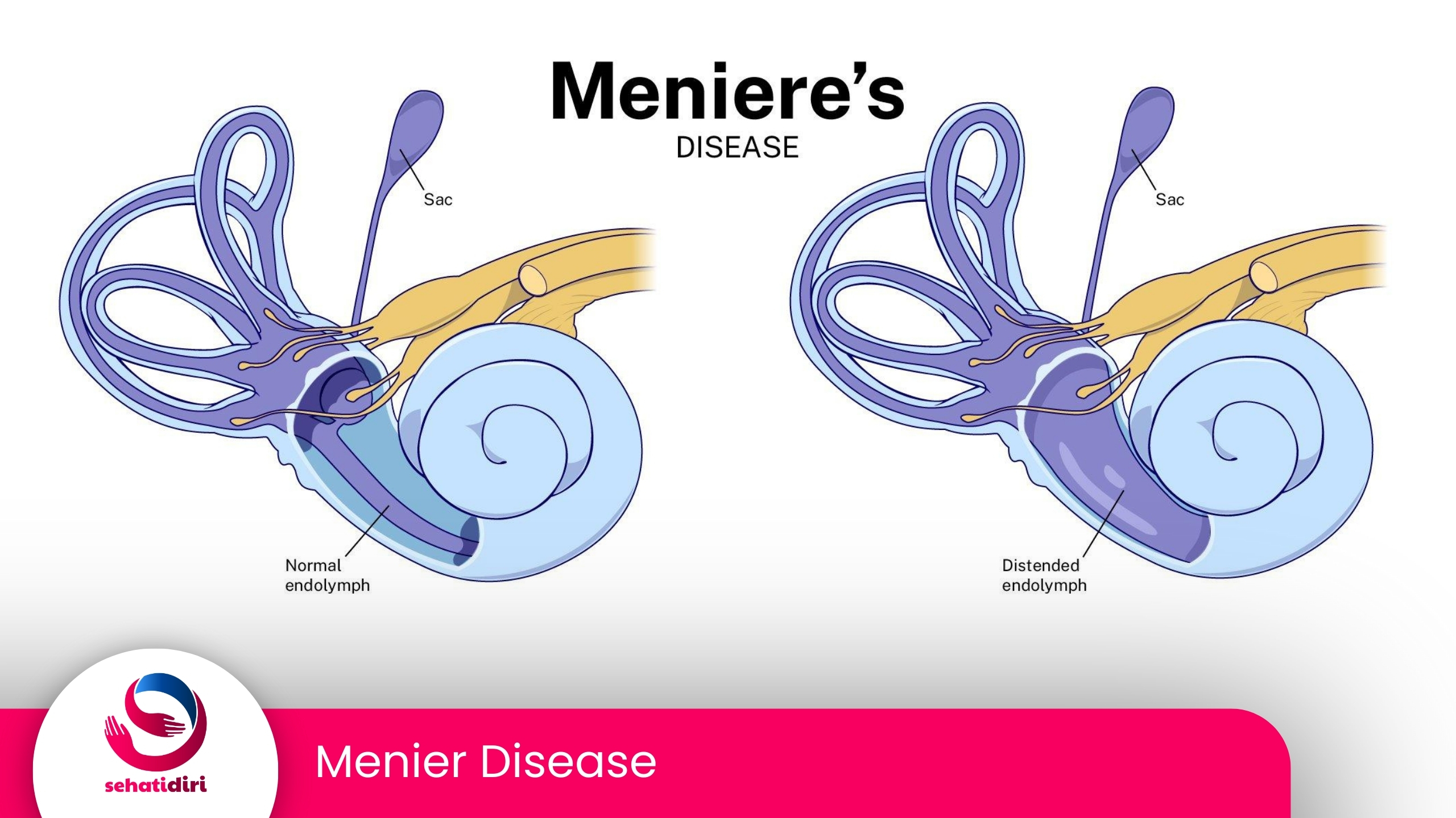 Menier Disease