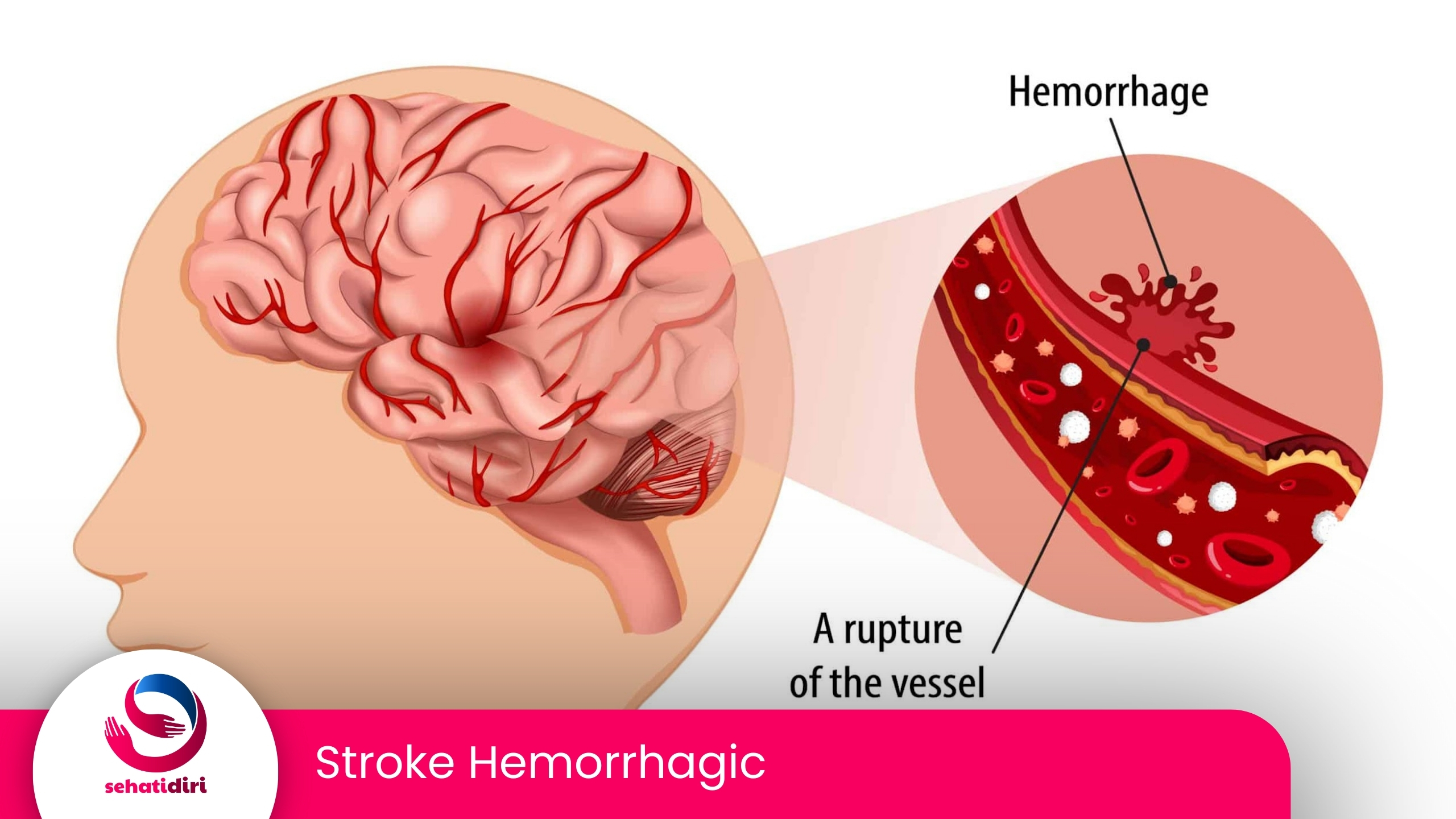 Stroke Hemorrhagic