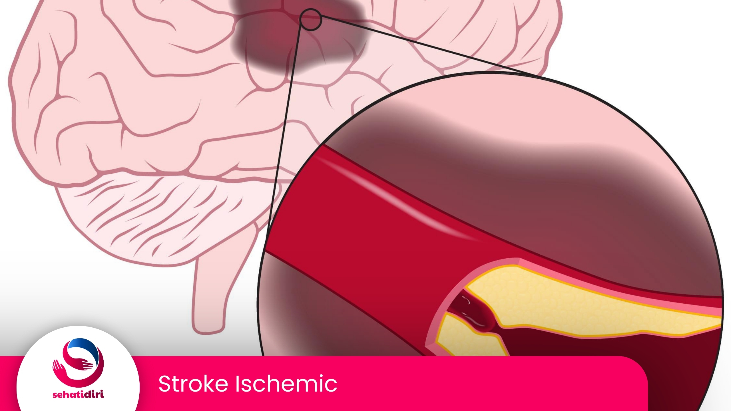 Stroke Ischemic