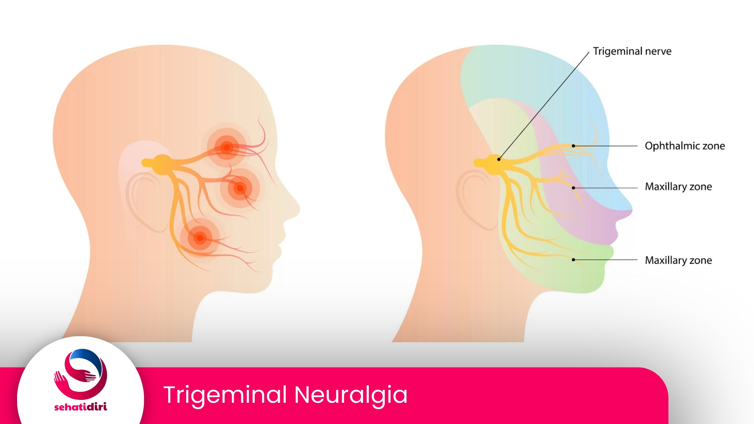 Trigeminal Neuralgia