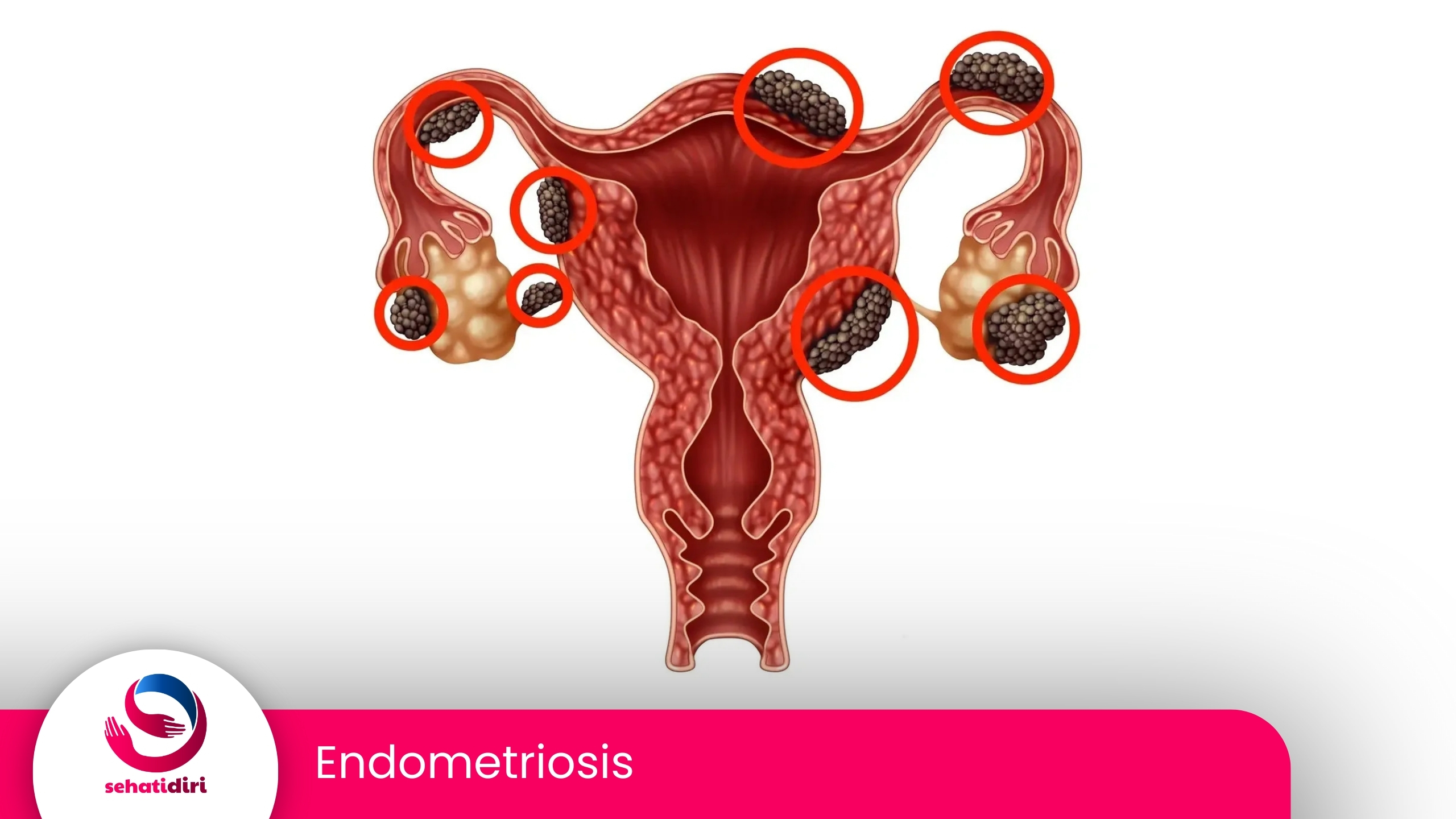 Endometriosis