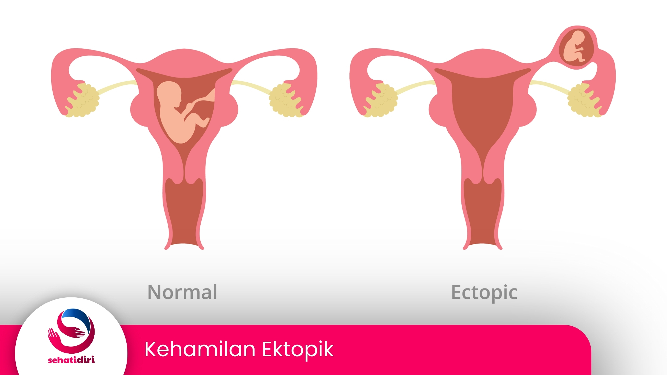 Kehamilan Ektopik