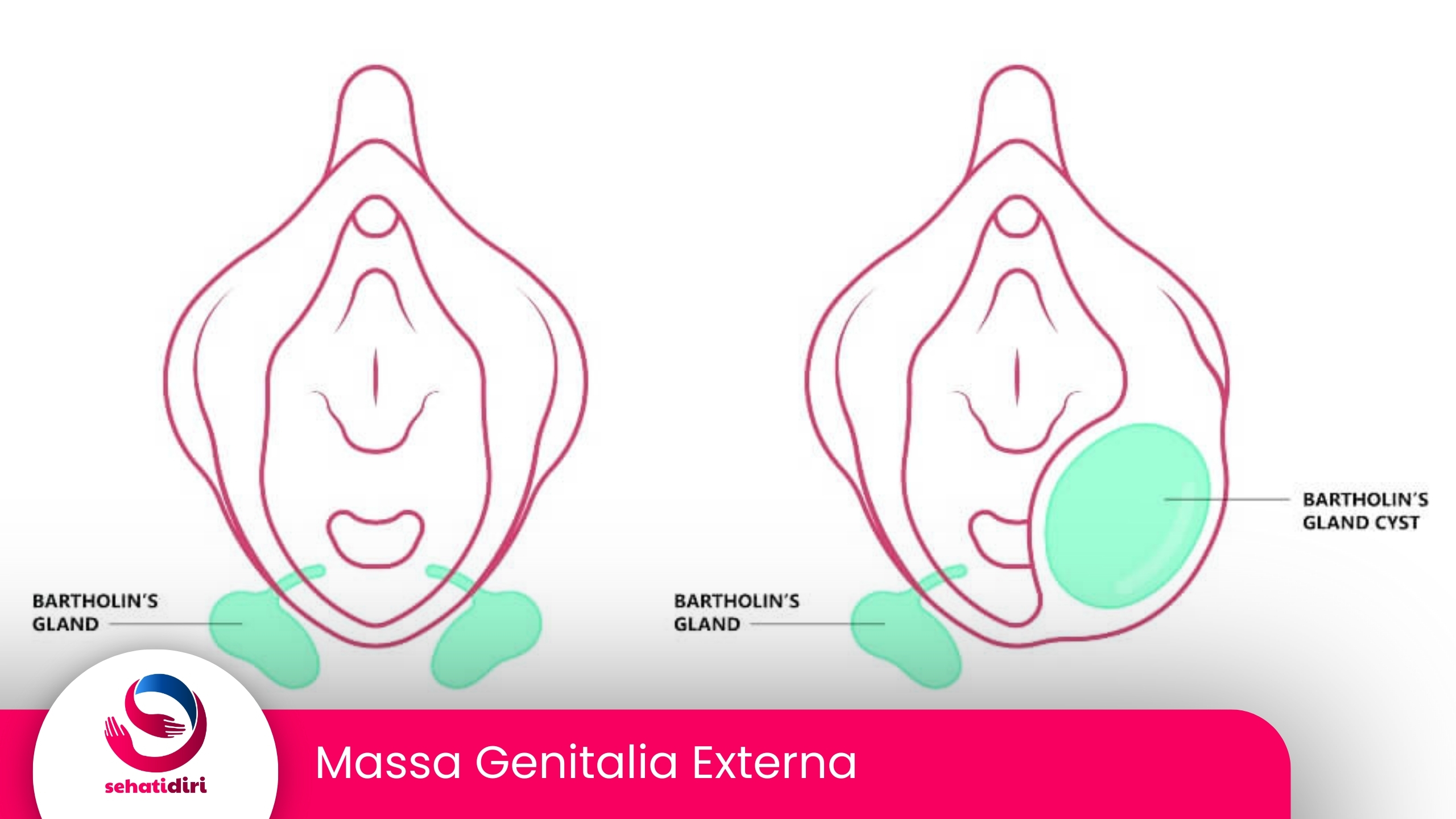 Massa Genitalia Externa