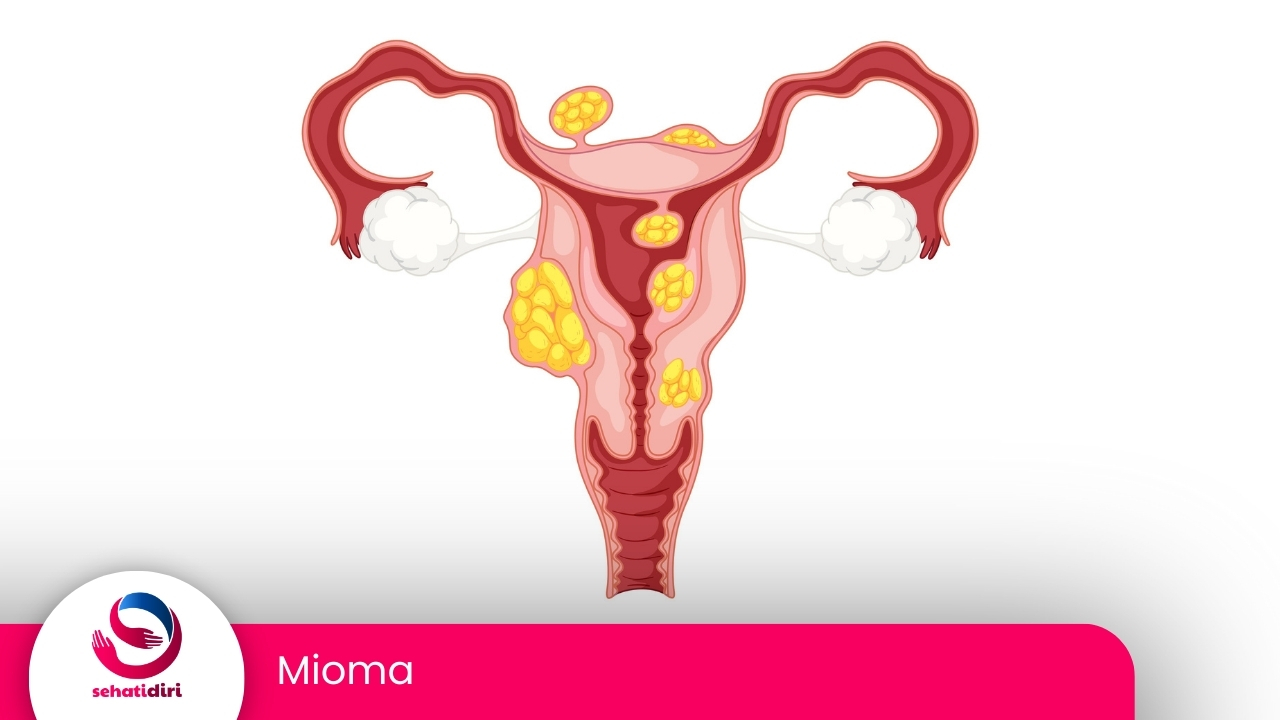 Mioma Uteri