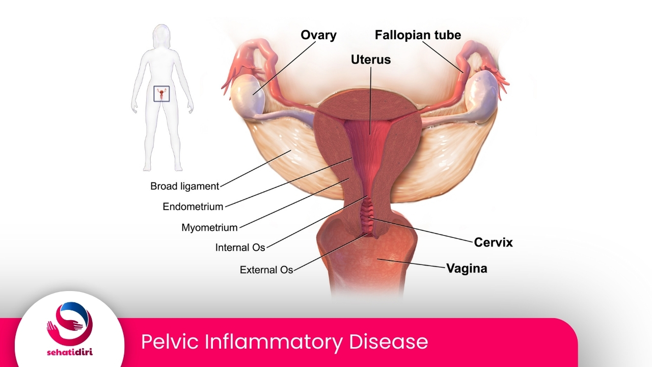 Pelvic Inflammatory Disease (PID)