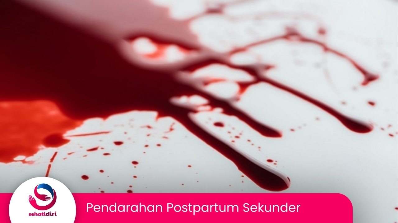 Pendarahan Postpartum Sekunder