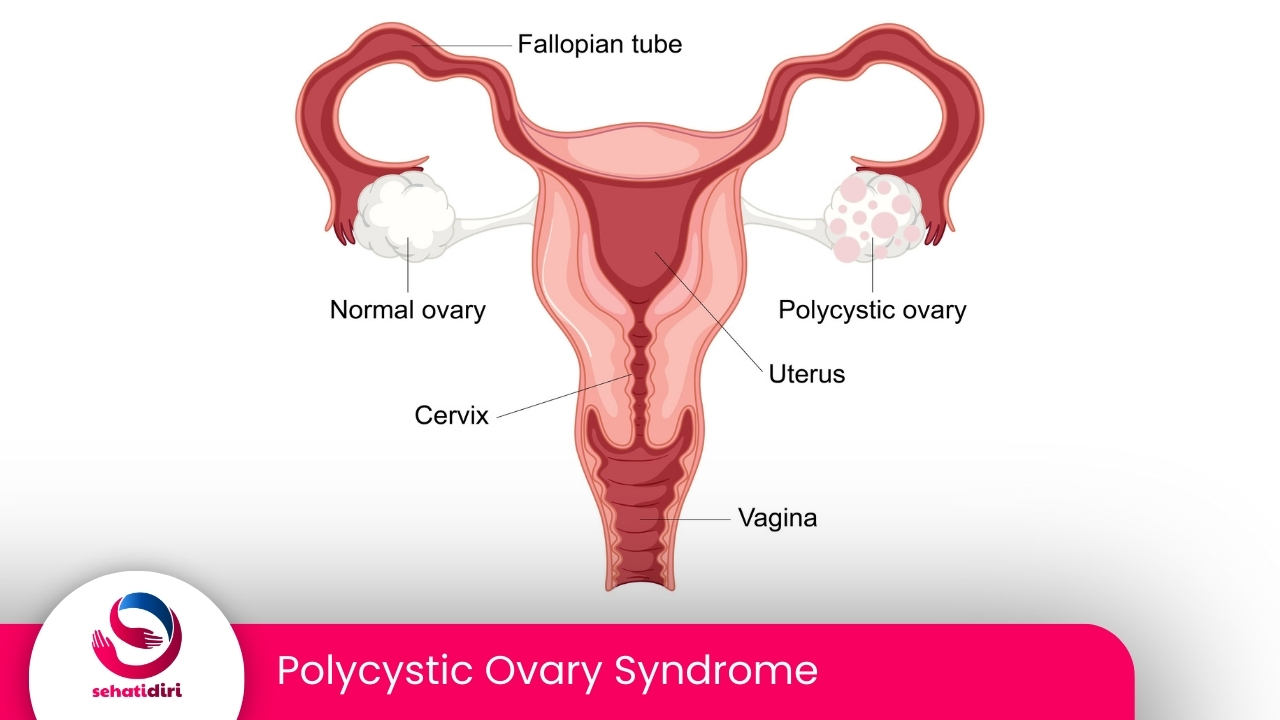 Polycystic Ovary Syndrome