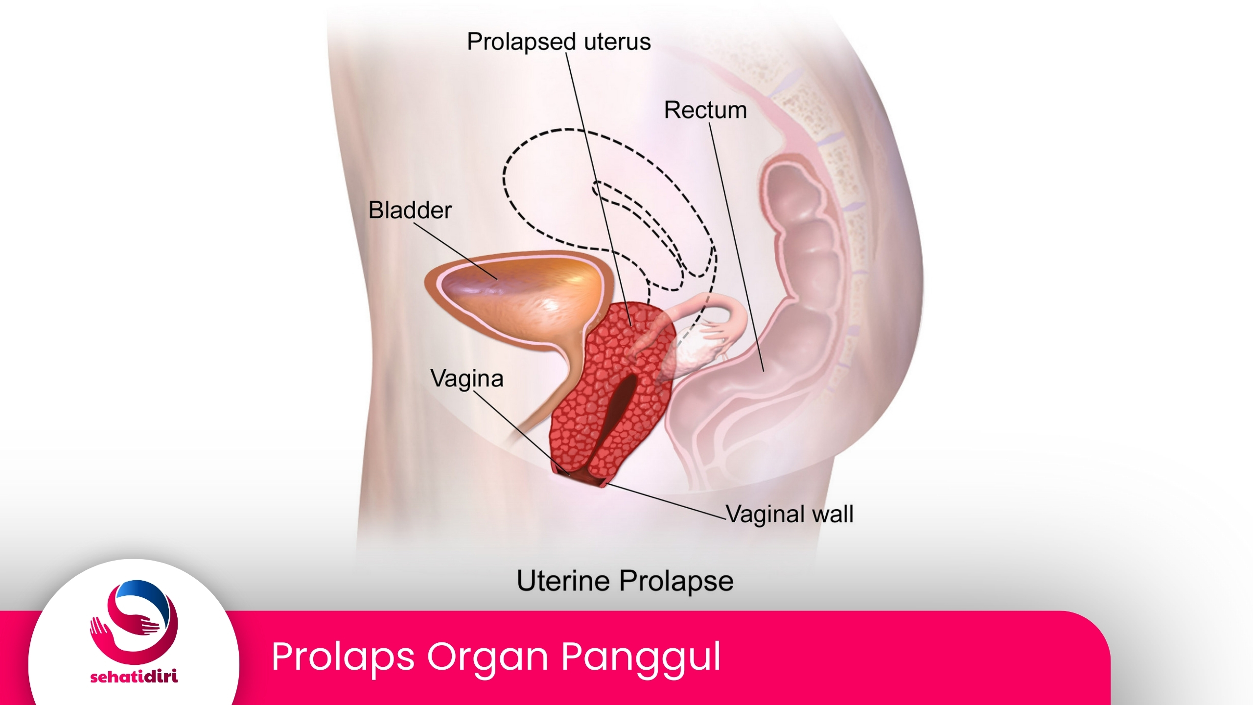 Prolaps Organ Panggul