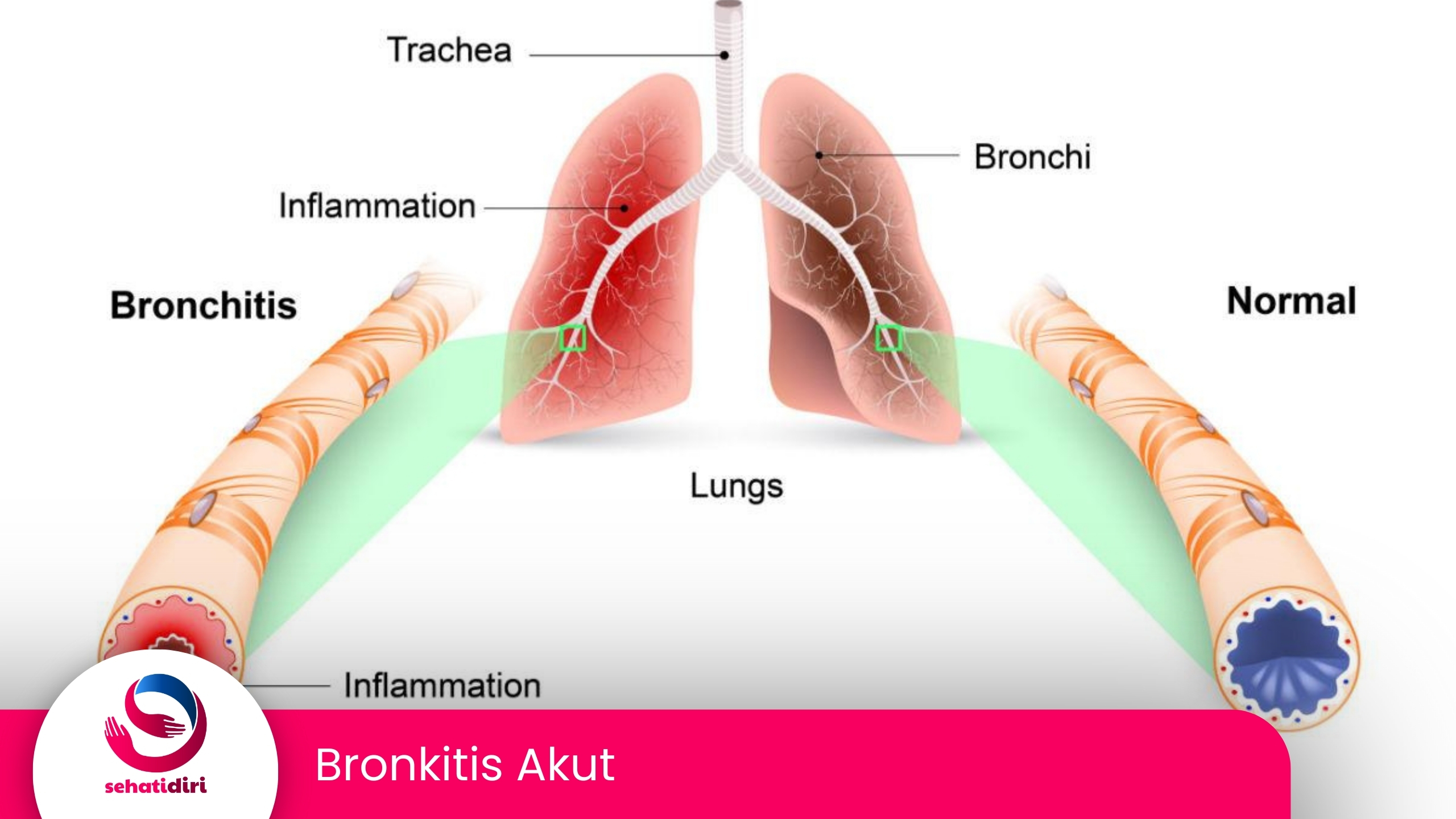 Bronkitis Akut