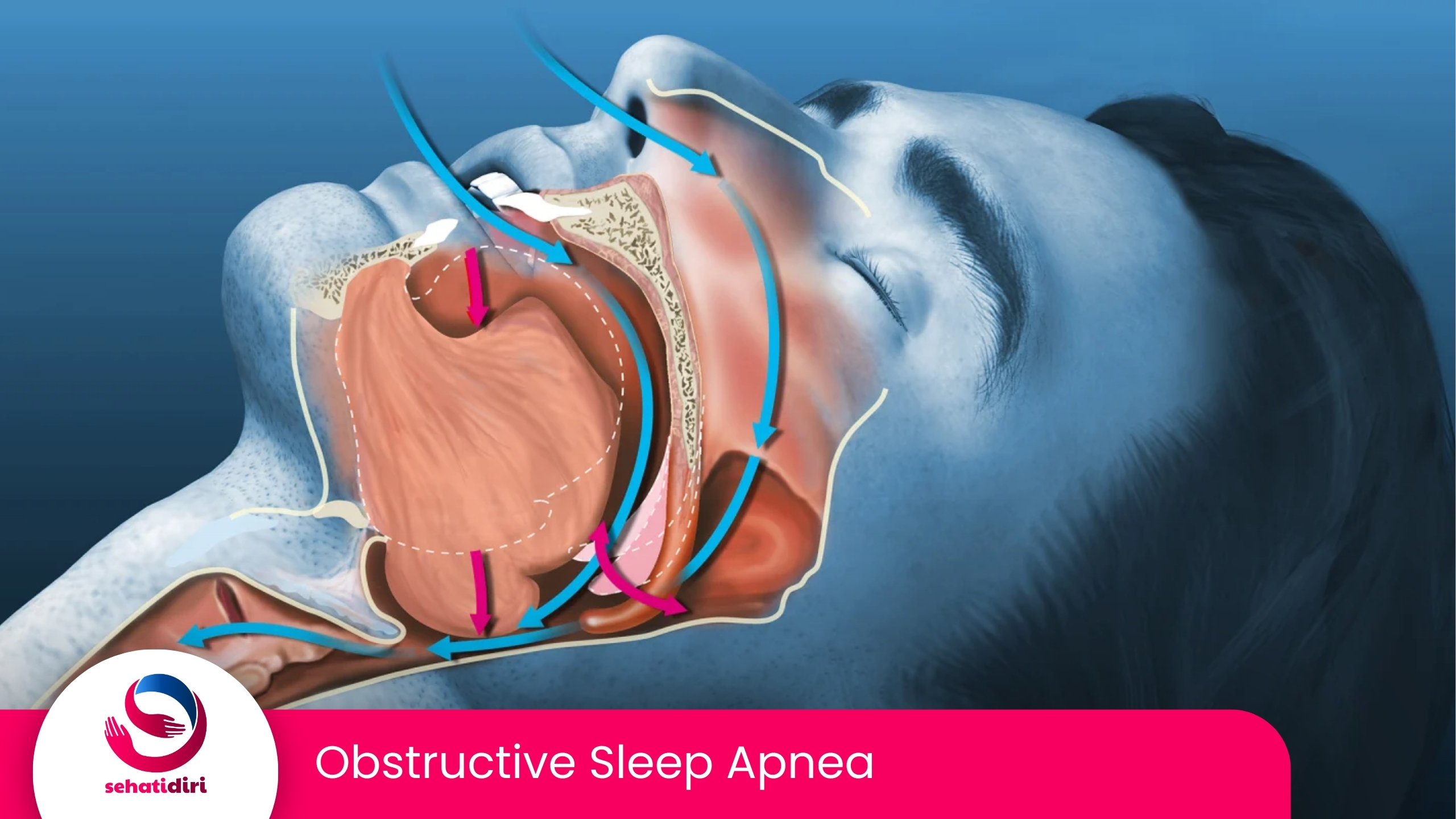 Obstructive Sleep Apnea