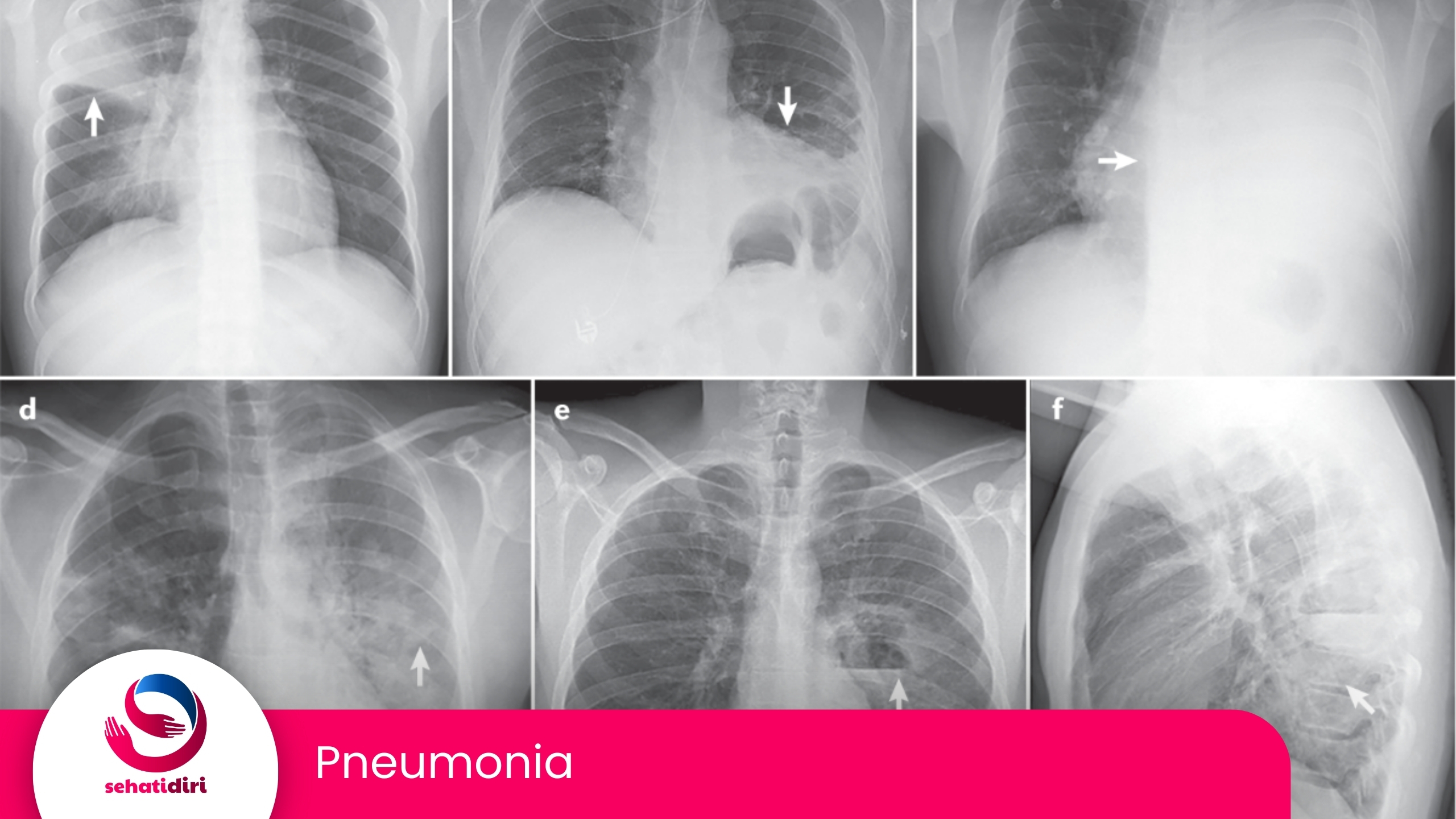 Pneumonia