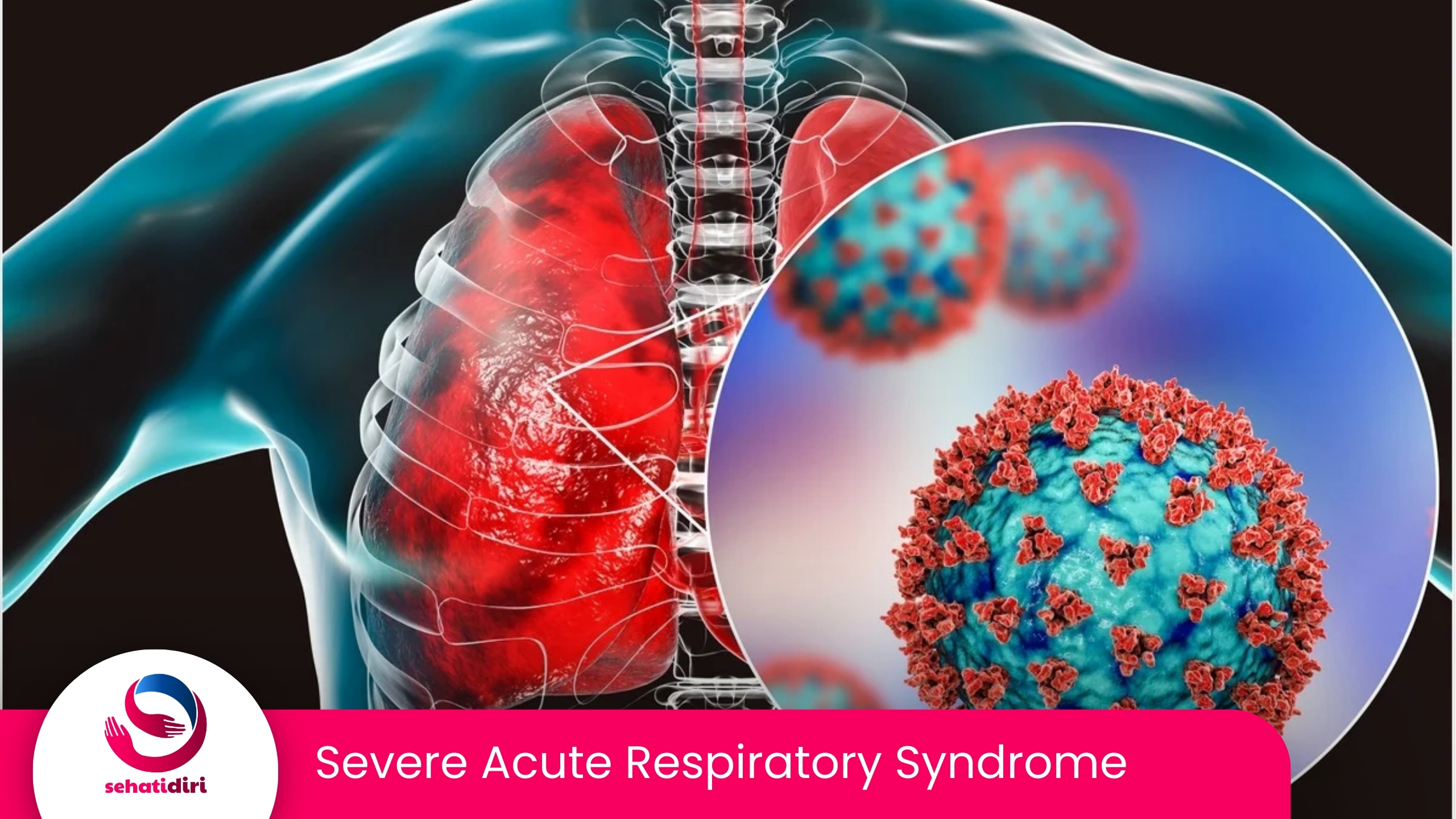 Severe Acute Respiratory Syndrome