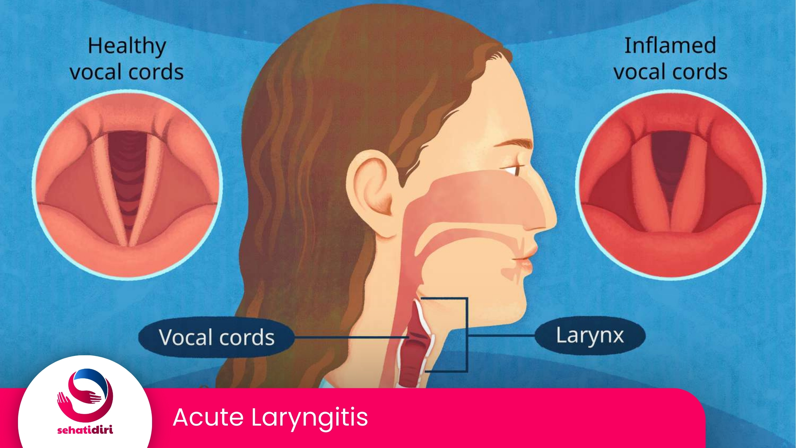 Acute Laryngitis