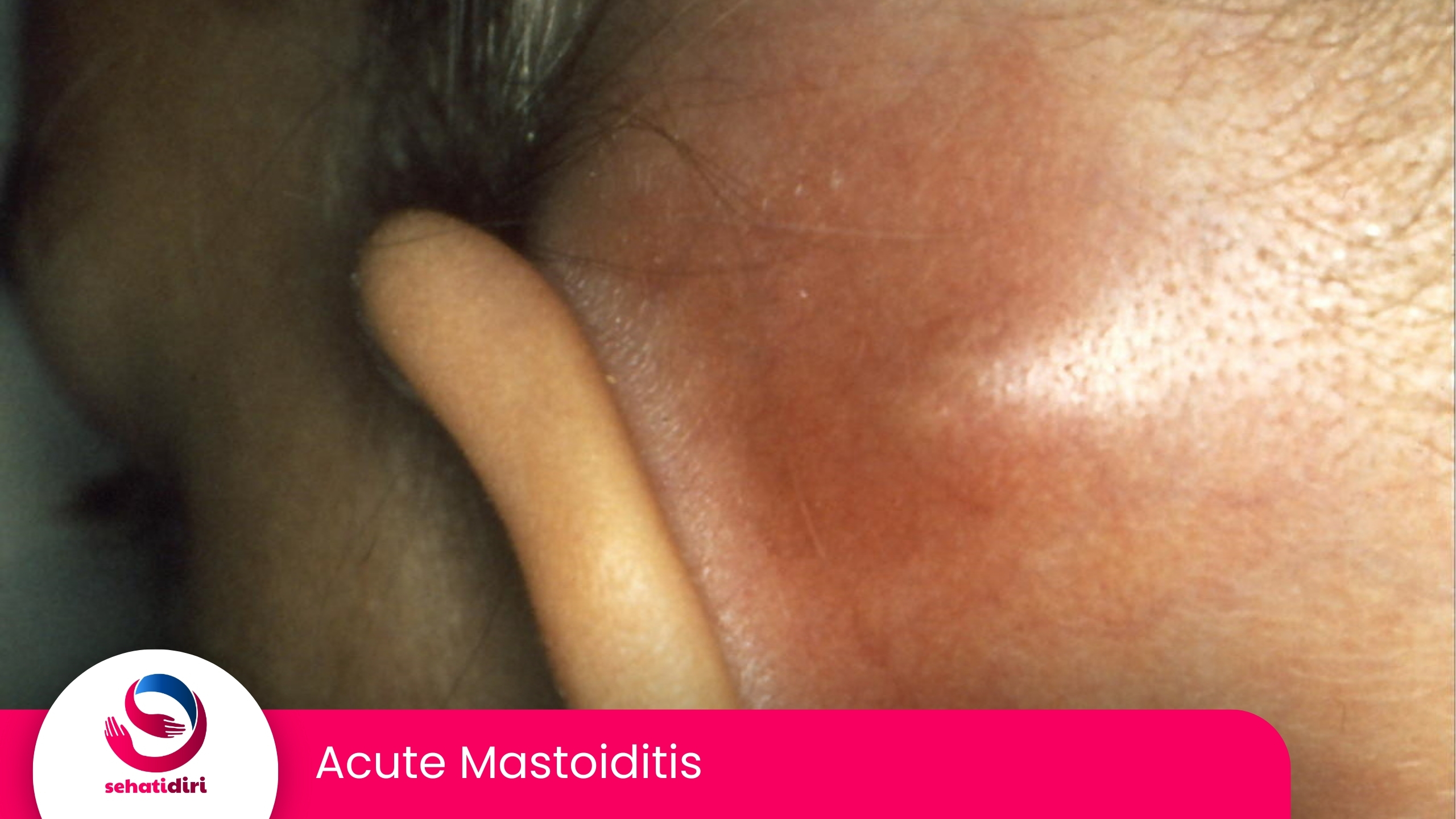 Acute Mastoiditis