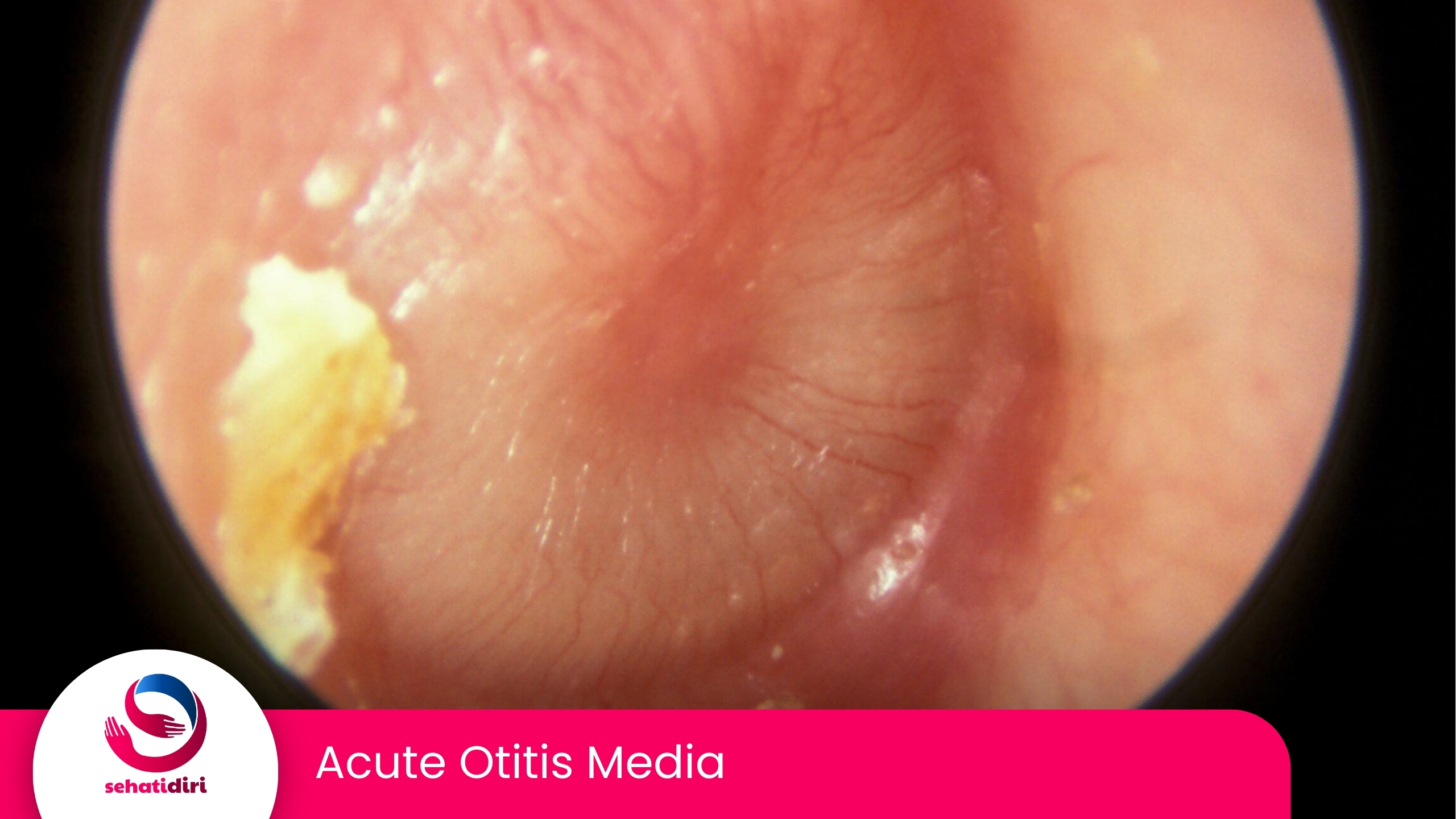 Acute Otitis Media