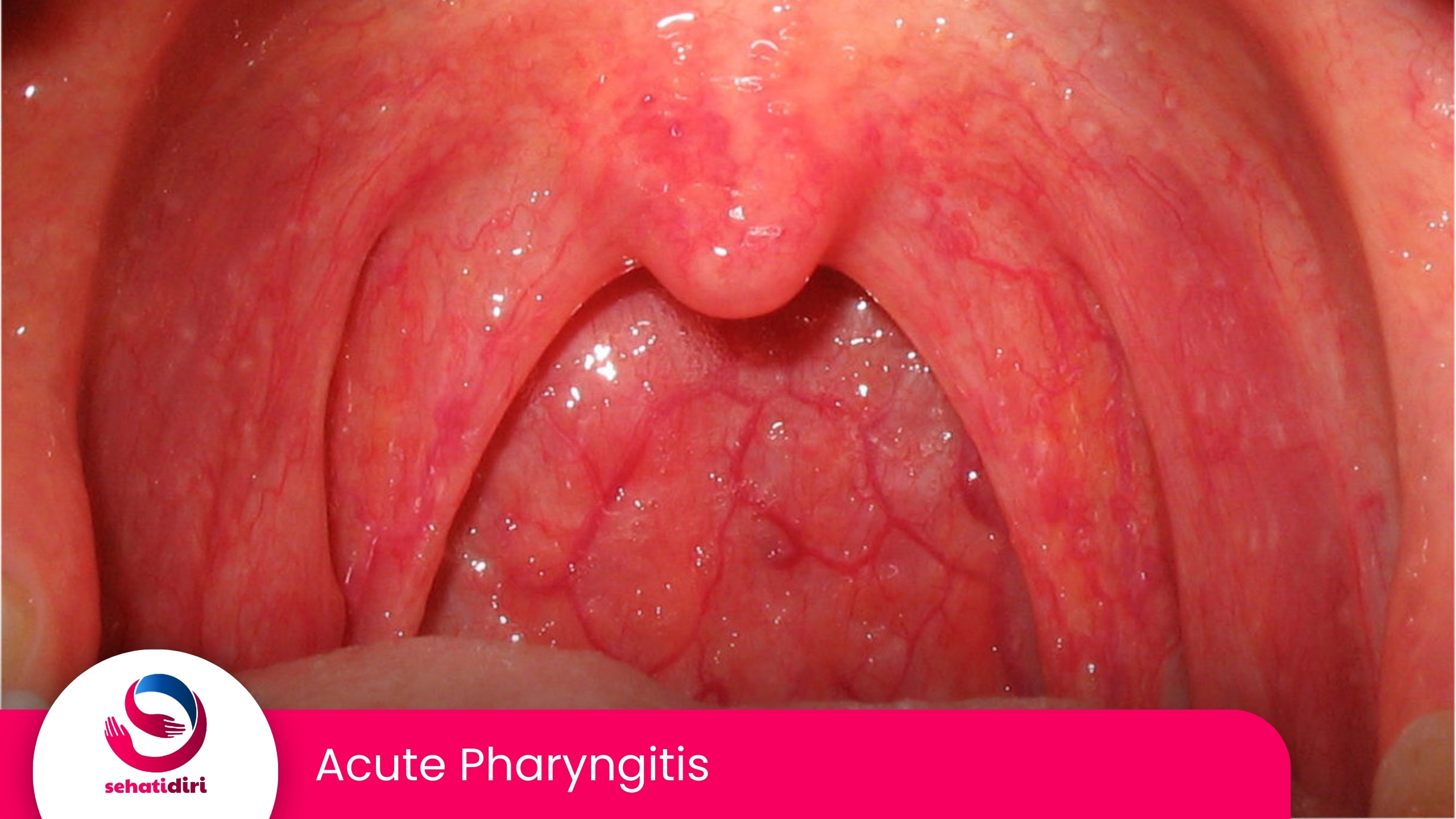 Acute Pharyngitis