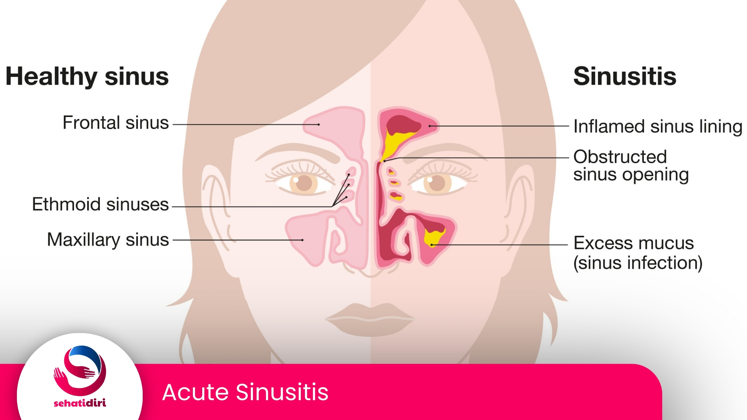 Acute Sinusitis