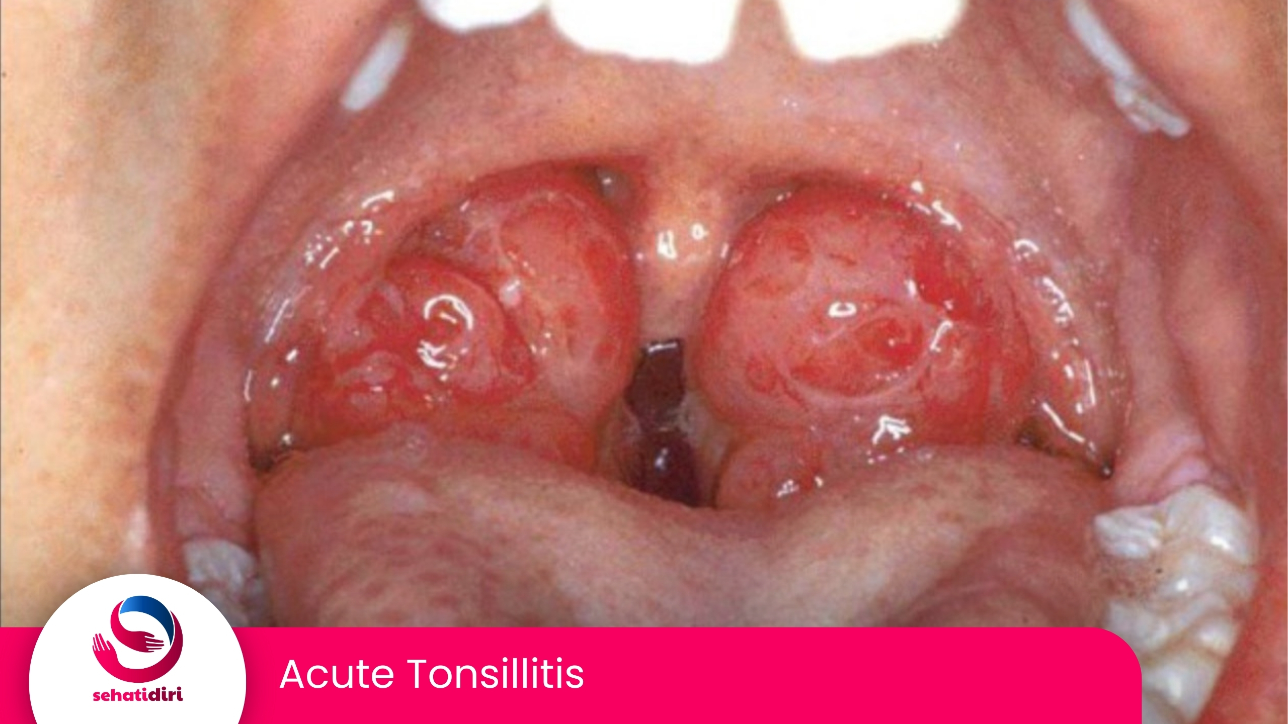 Acute Tonsillitis