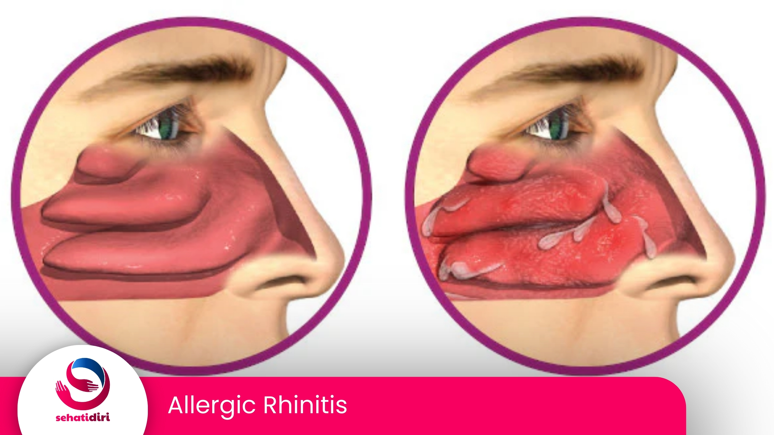 Allergic Rhinitis