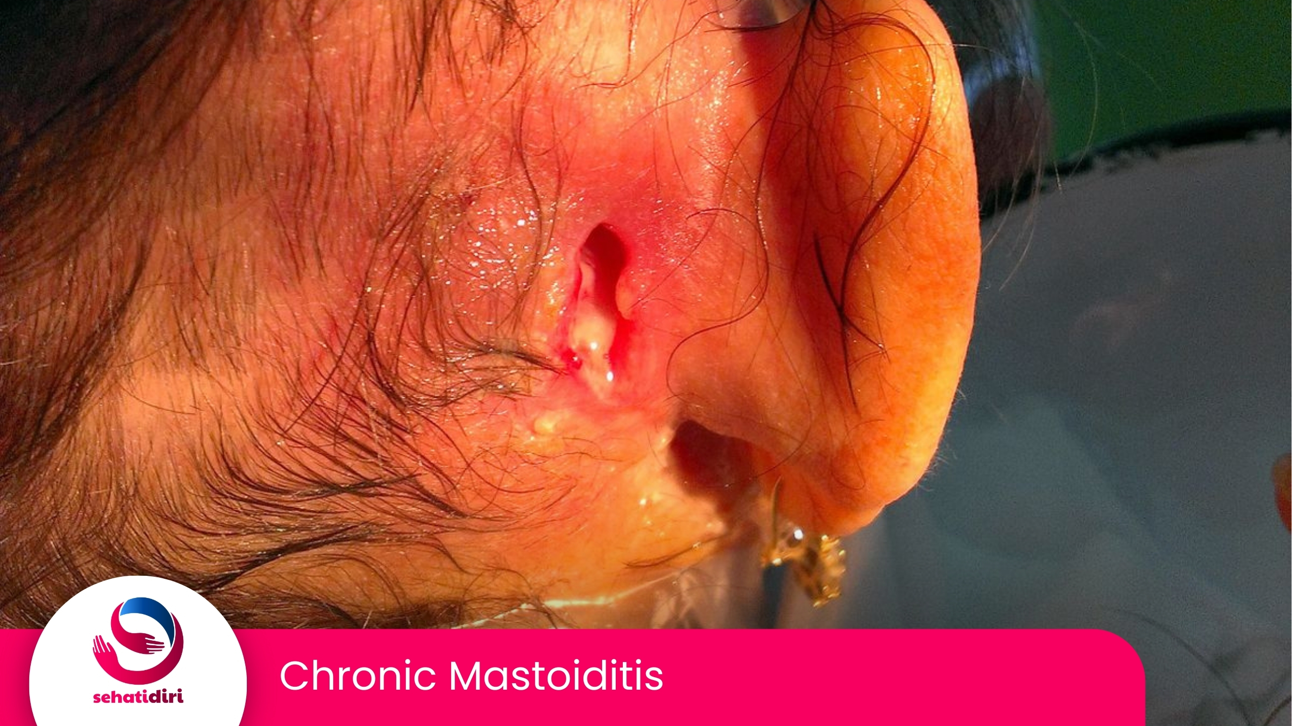 Chronic Mastoiditis