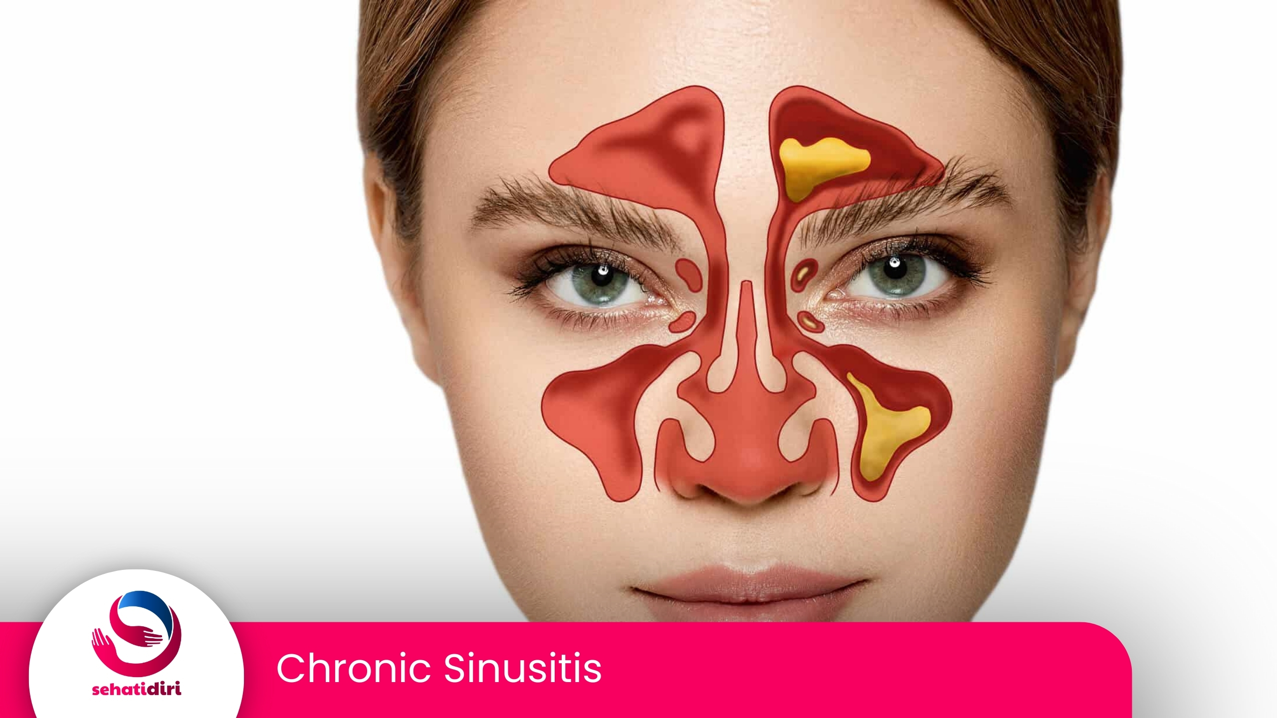 Chronic Sinusitis