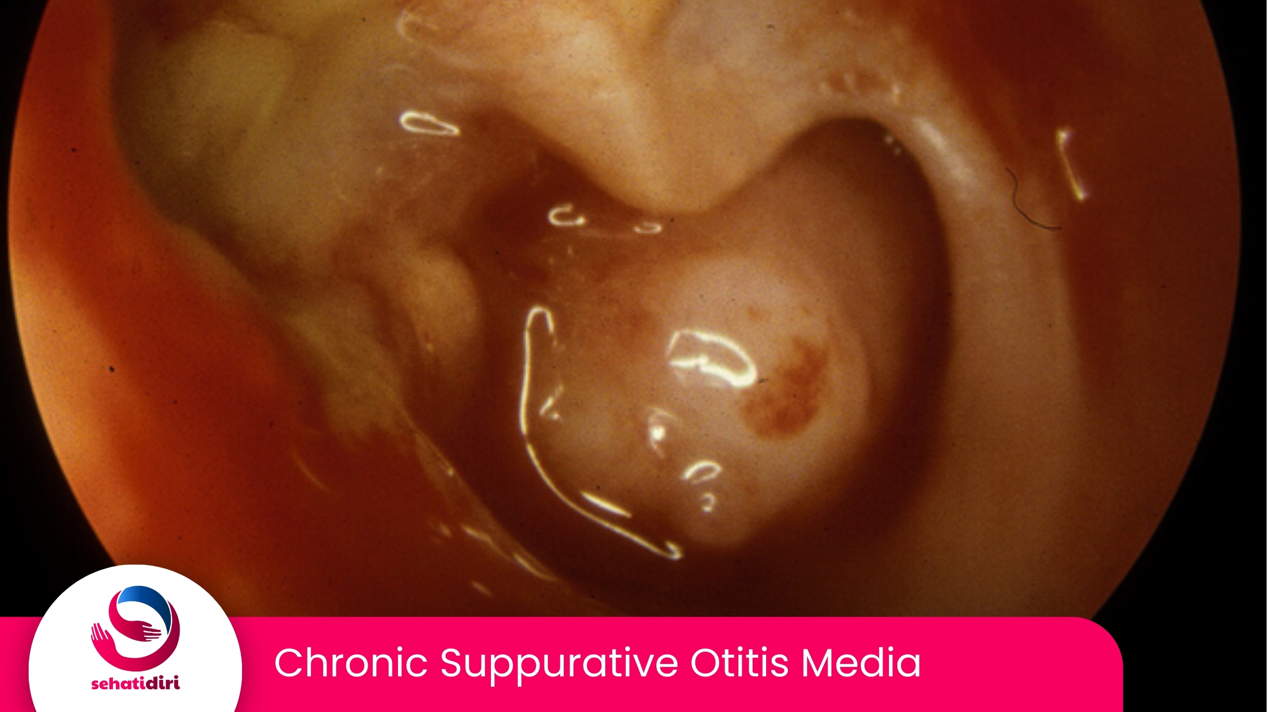 Chronic Suppurative Otitis Media