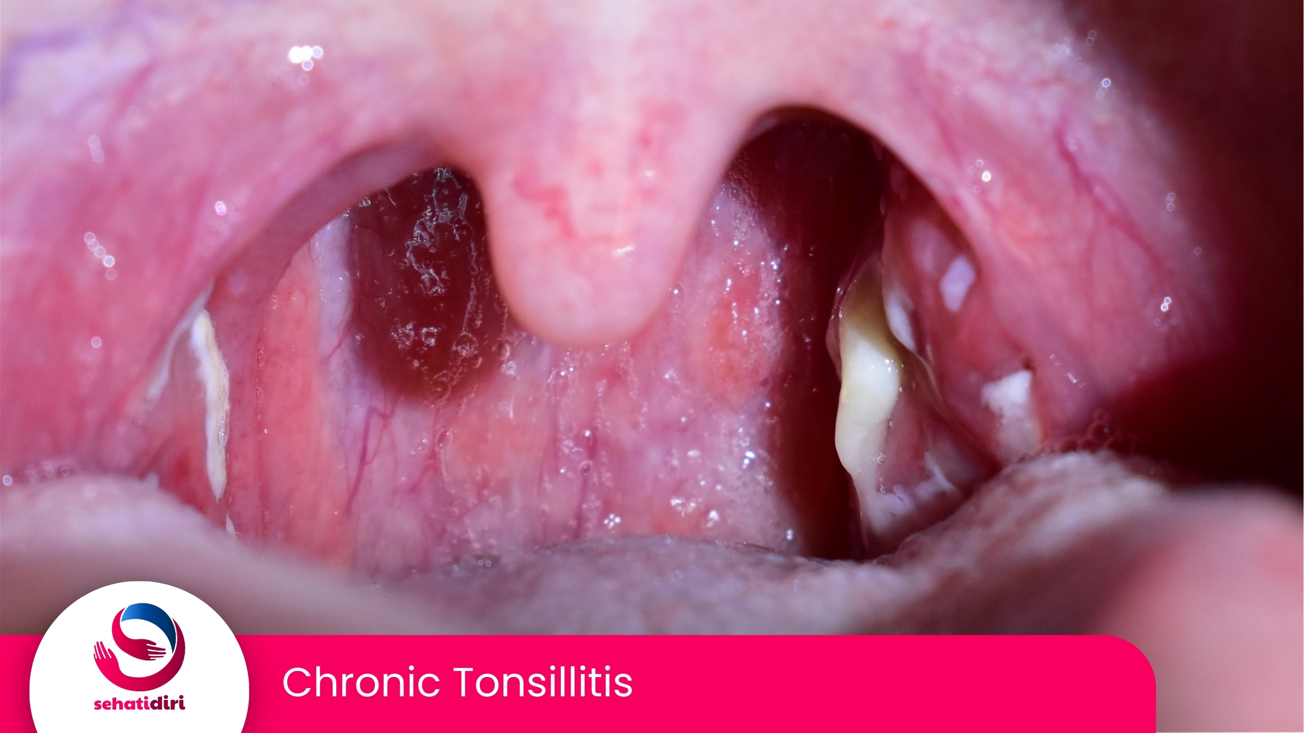 Chronic Tonsilitis