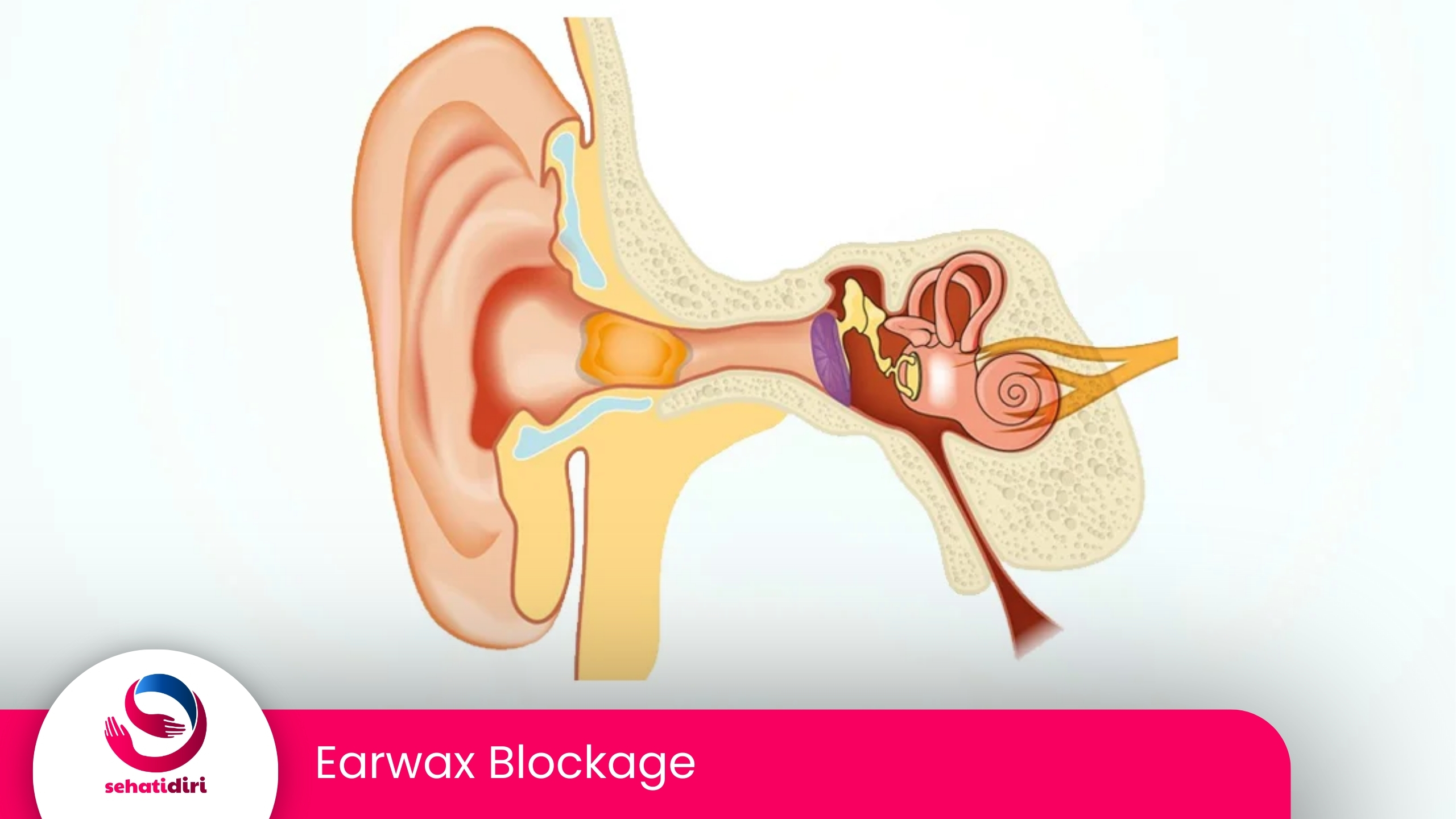 Earwax Blockage