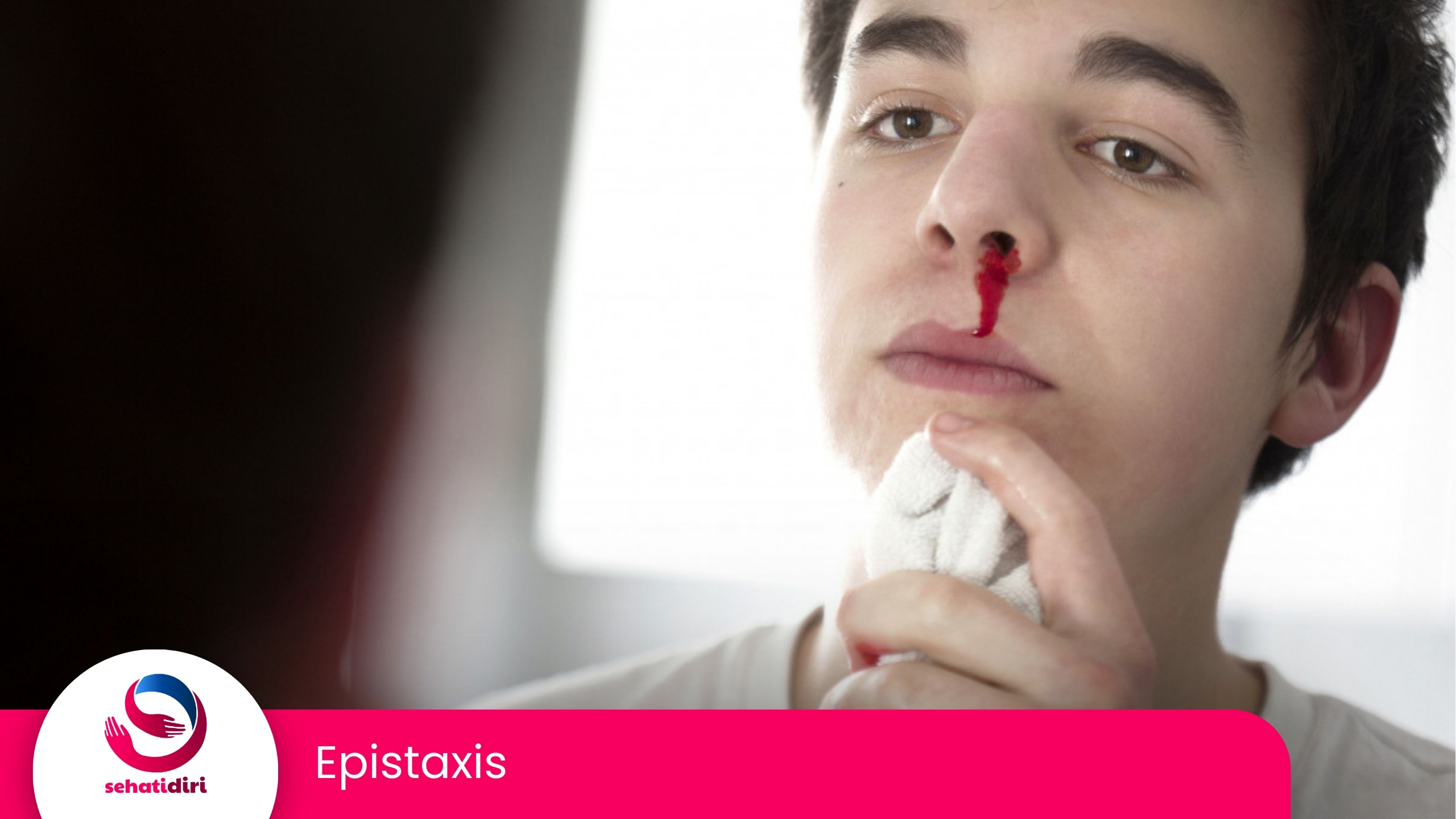 Epistaxis