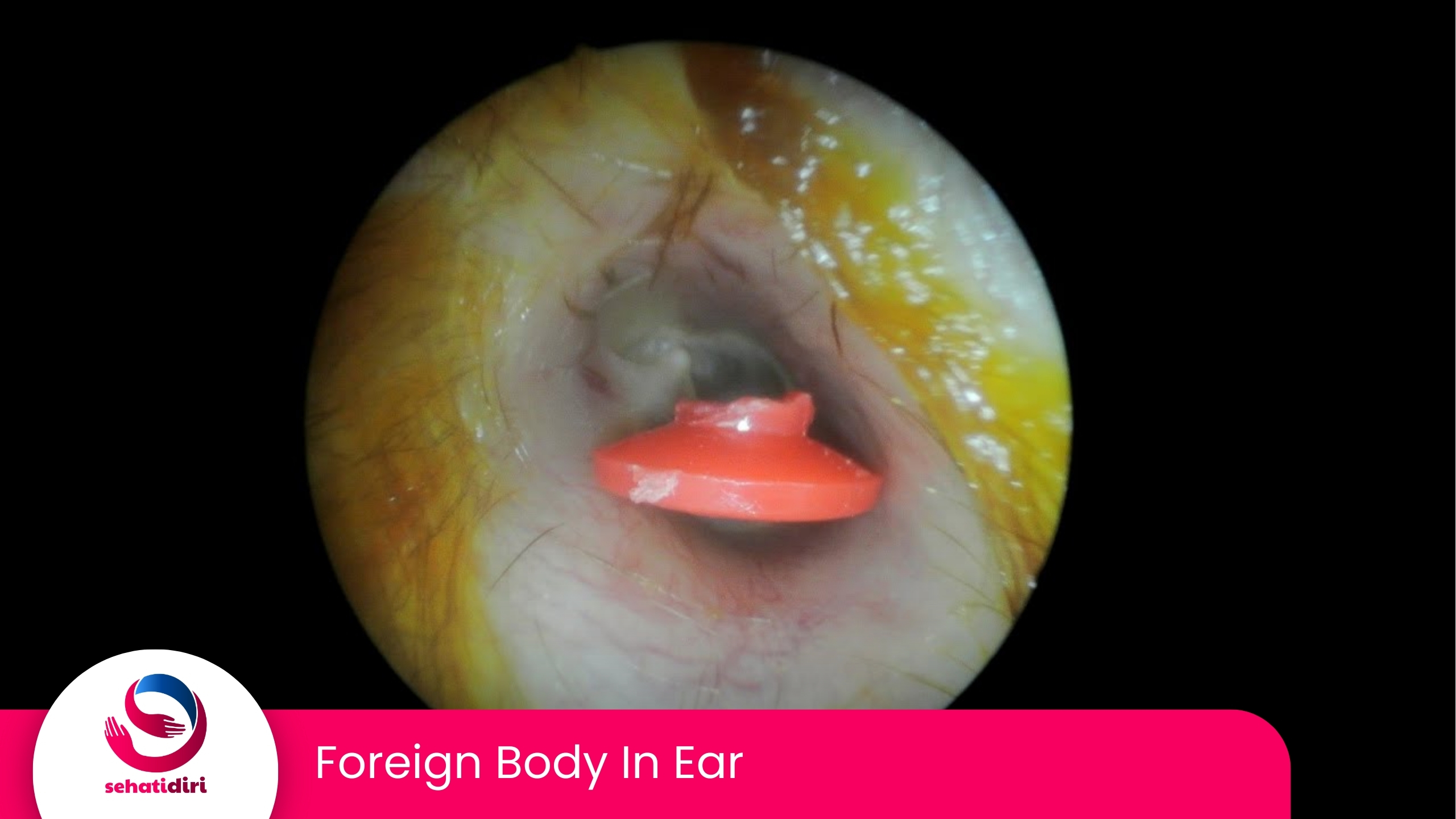 Foreign Body in Ear