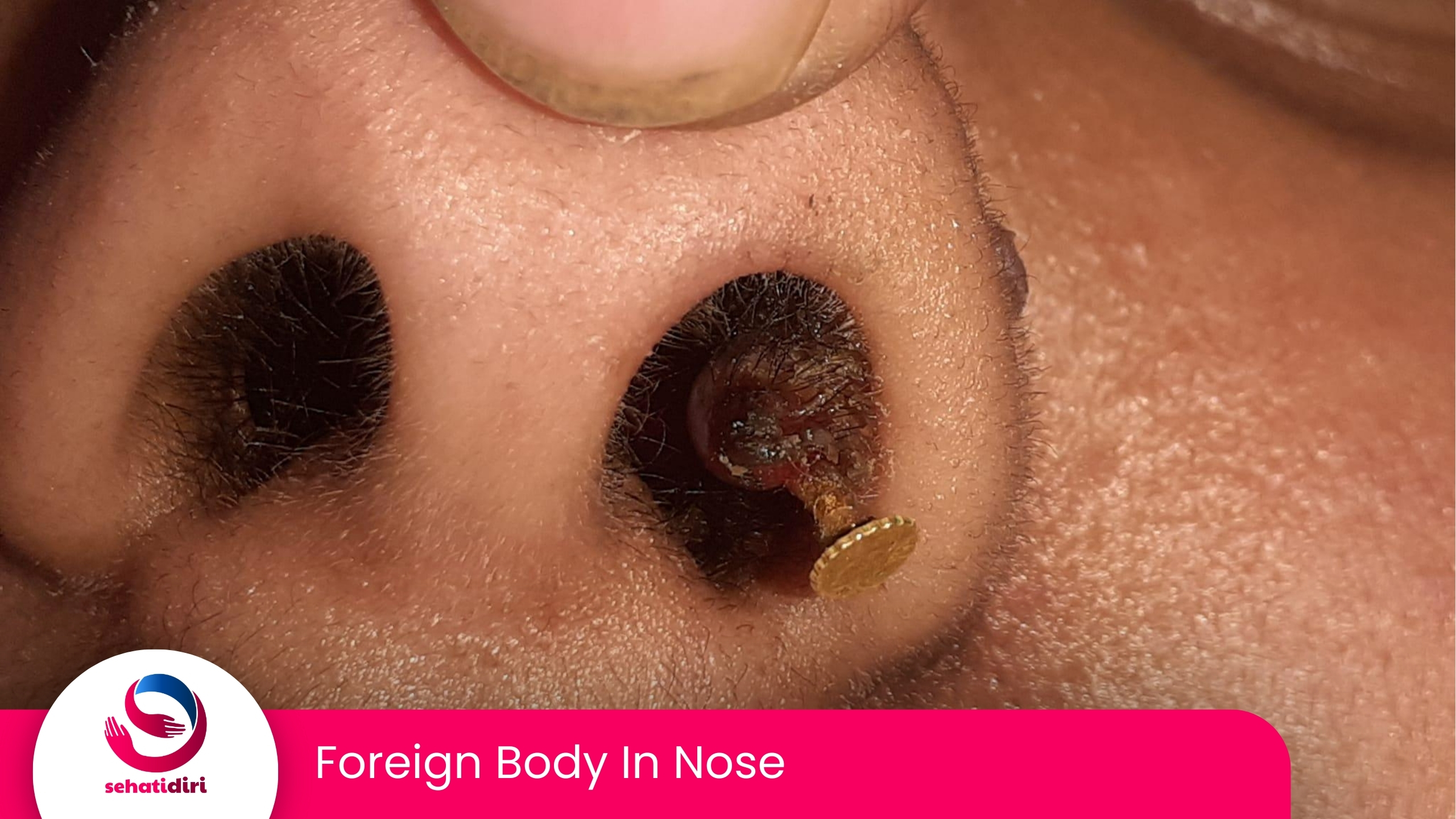 Foreign Body In Nose