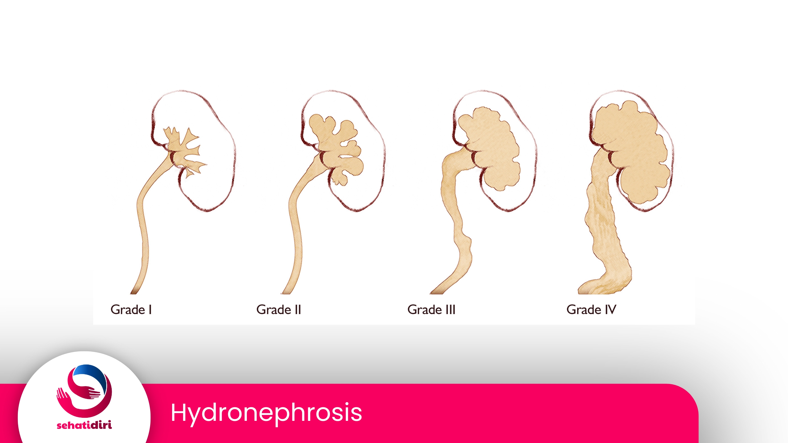 Hydronephrosis