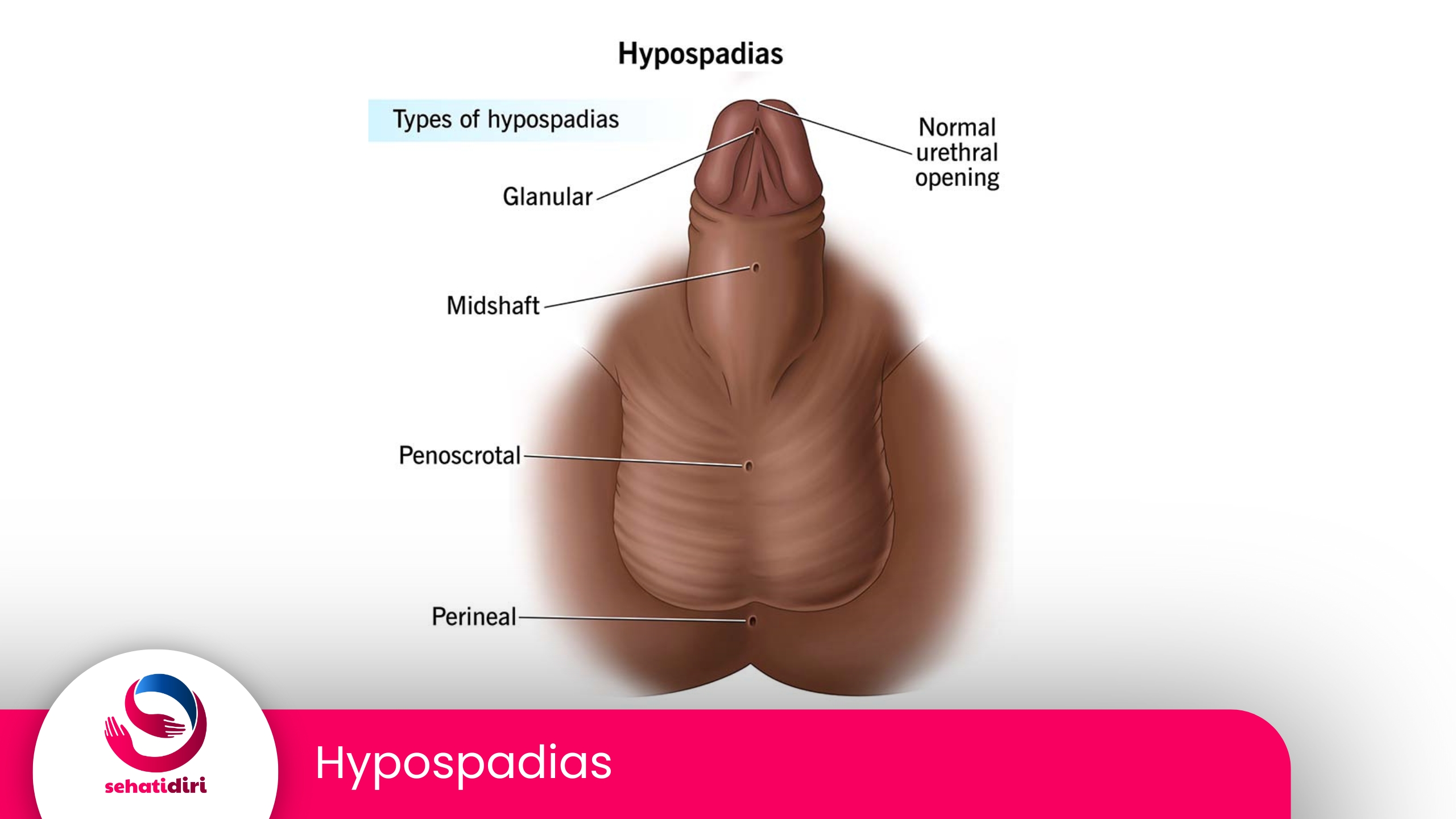 Hypospadias