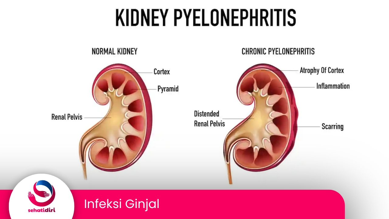 Infeksi Ginjal