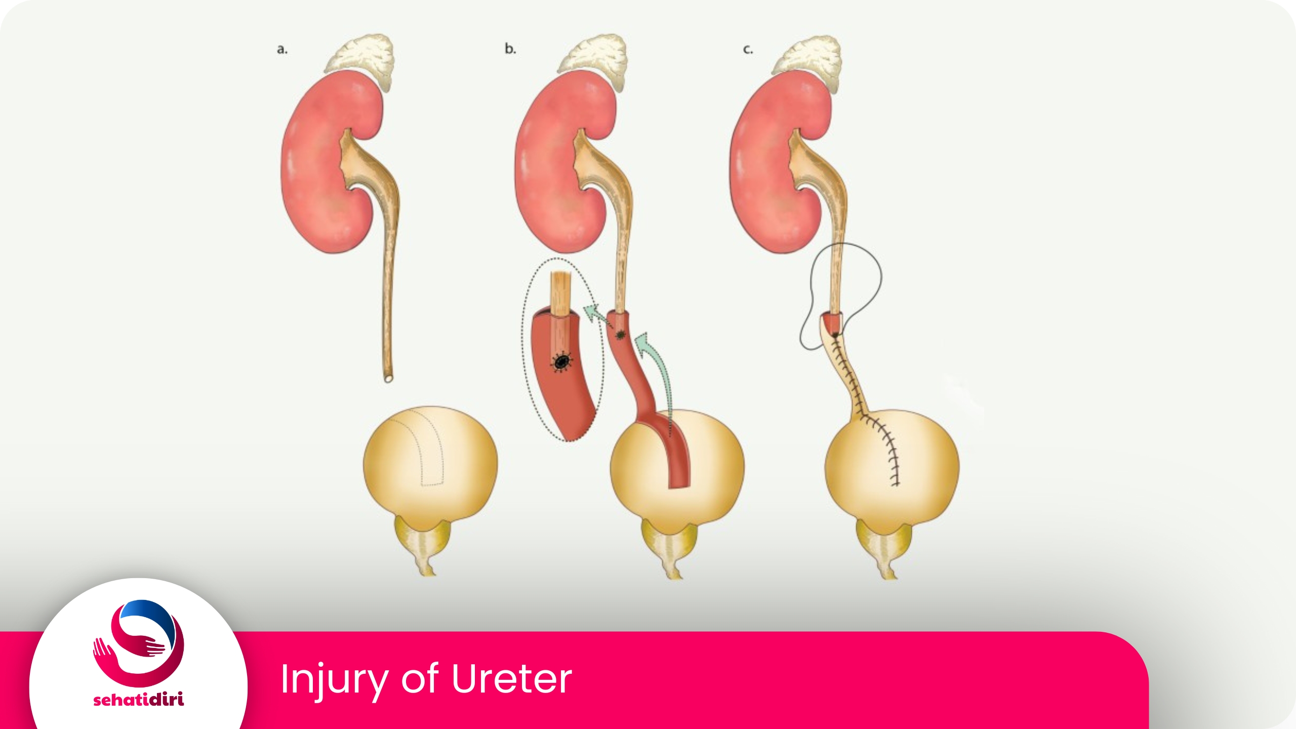 Cedera Ureter