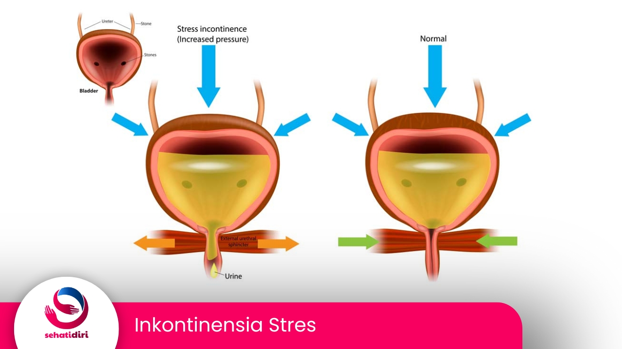 Inkontinensia Stres