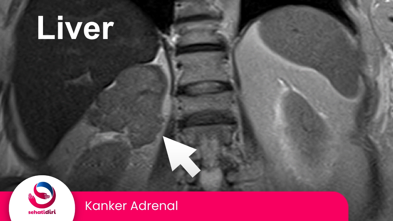 Kanker Adrenal