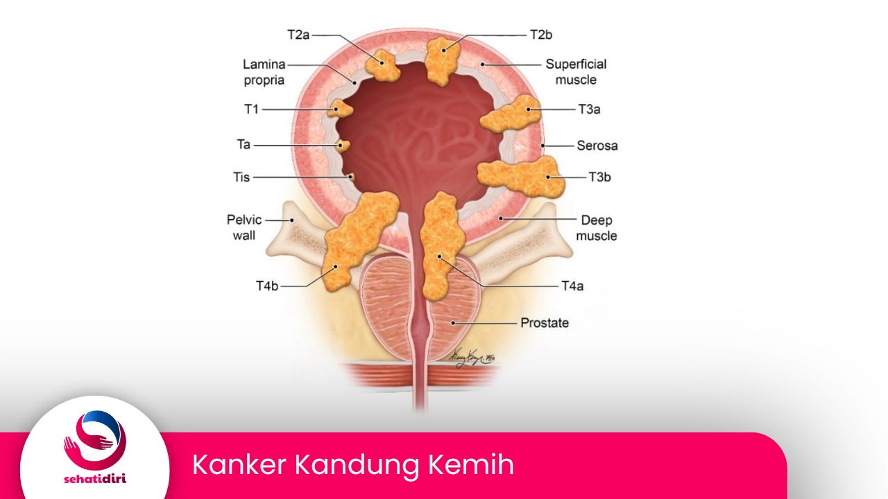 Kanker Kandung Kemih