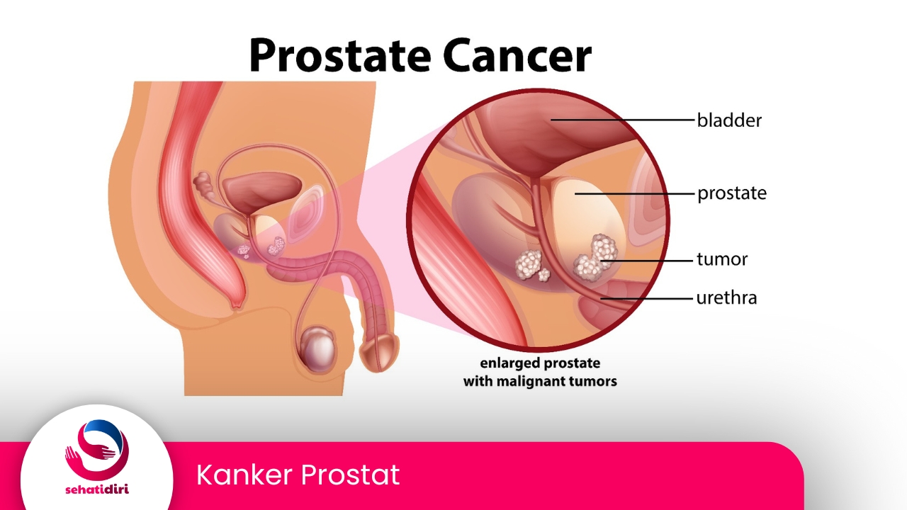 Kanker Prostat