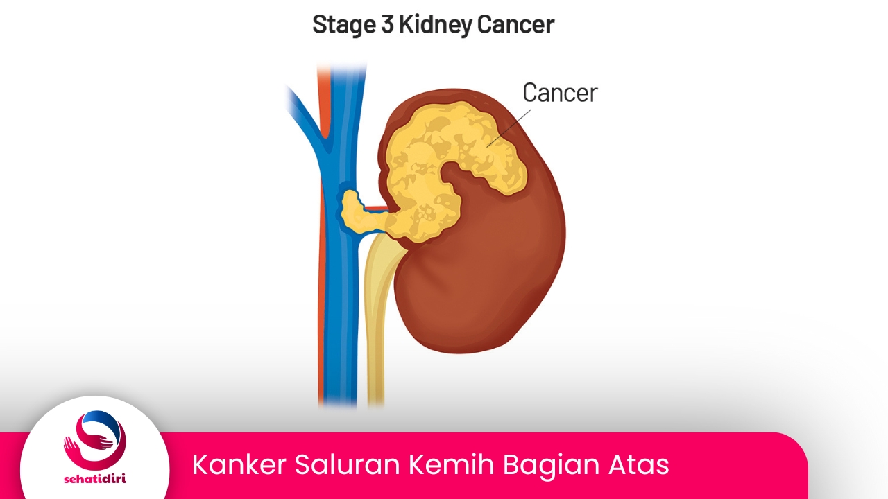 Kanker Saluran Kemih Bagian Atas