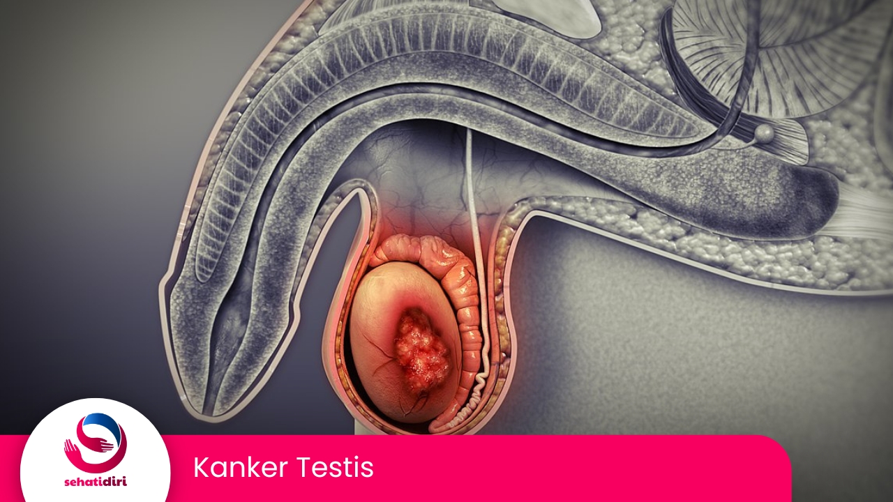 Kanker Testis