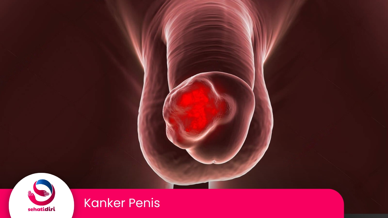 Kanker Penis