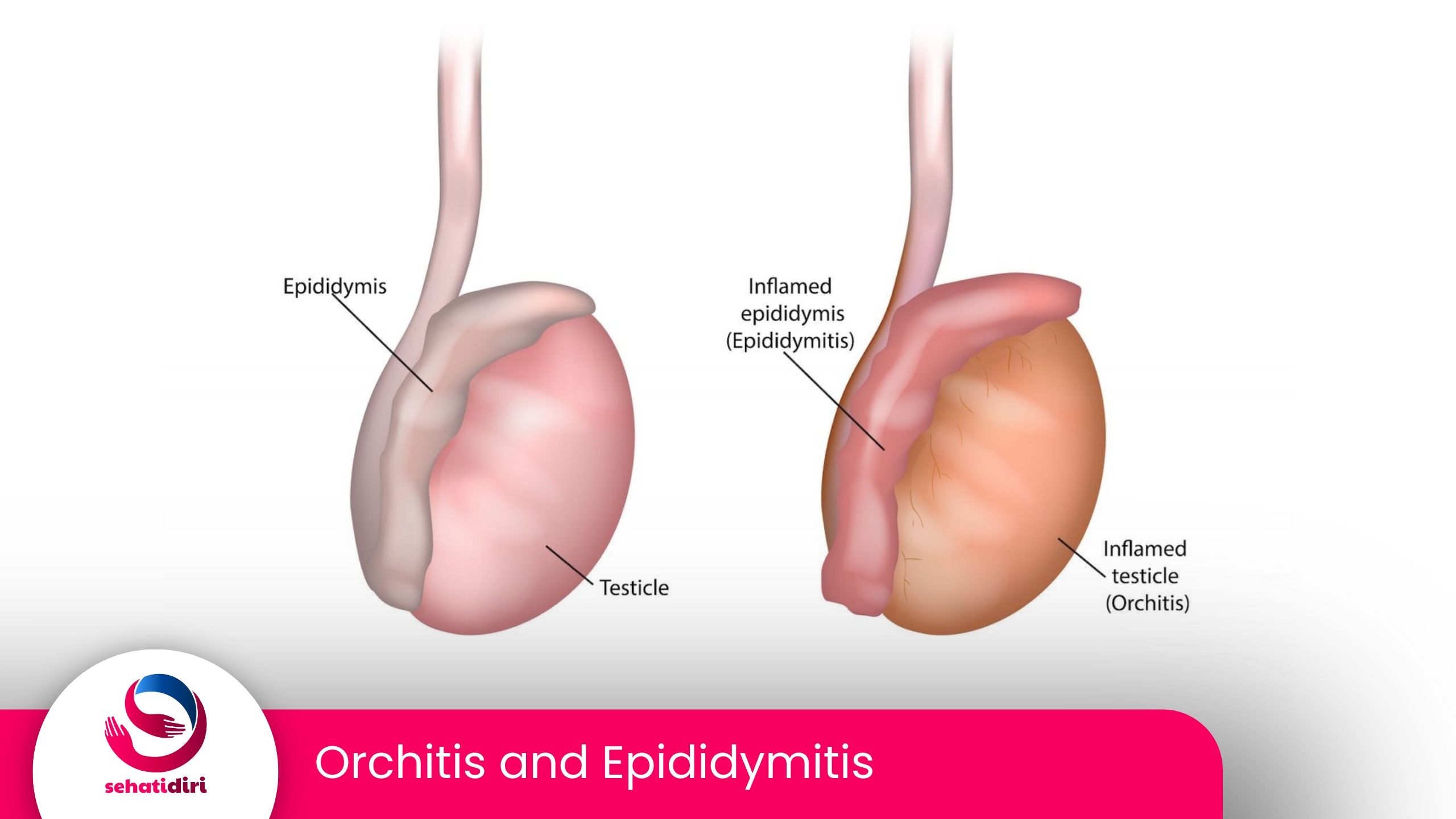 Epididymo-orchitis