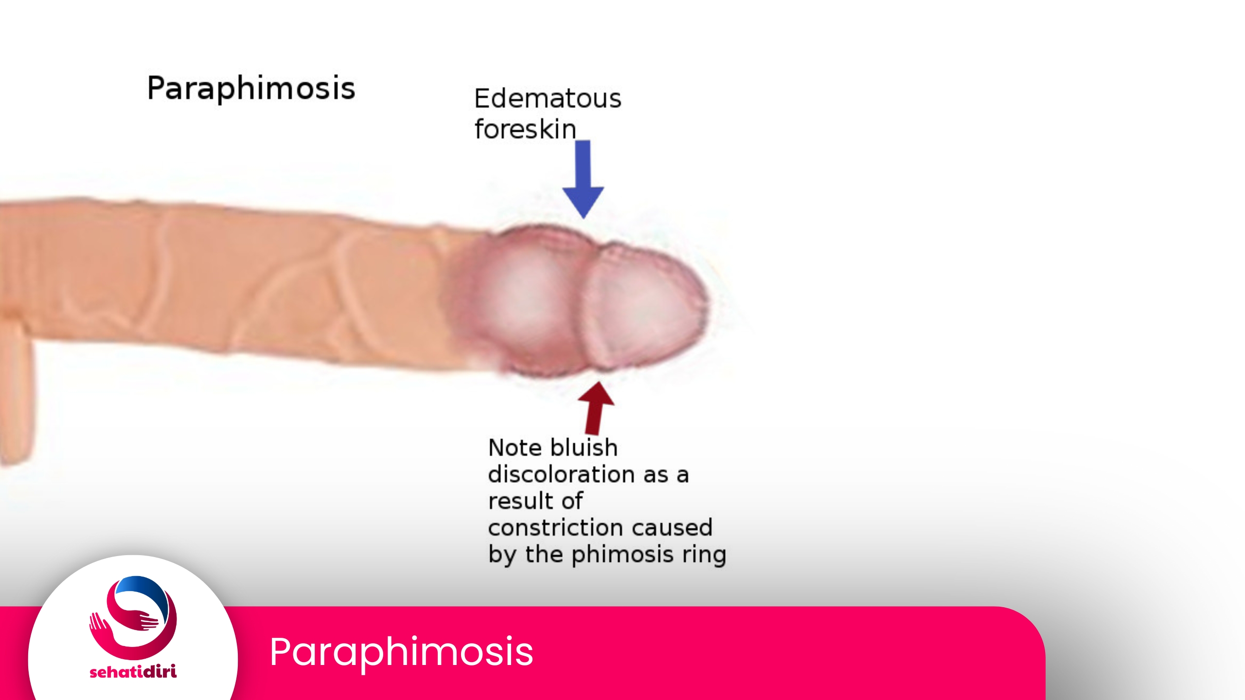 Paraphimosis