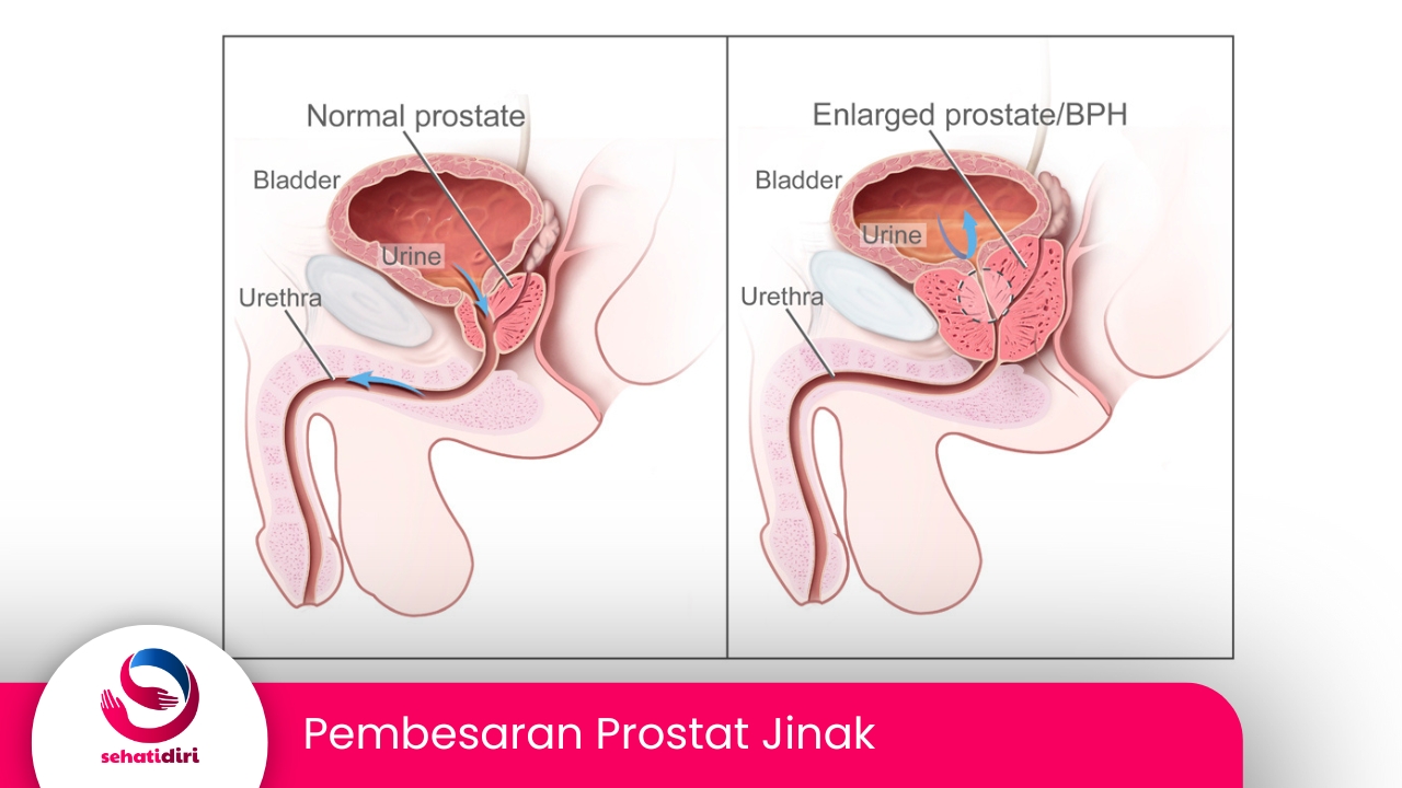 Pembesaran Prostat Jinak